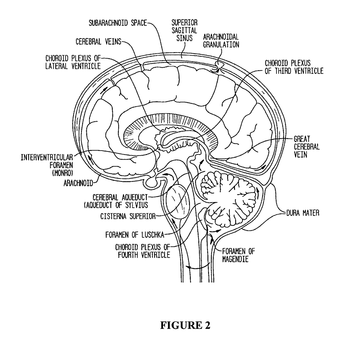 Compositions and their use to treat complications of aneurysmal subarachnoid hemorrhage