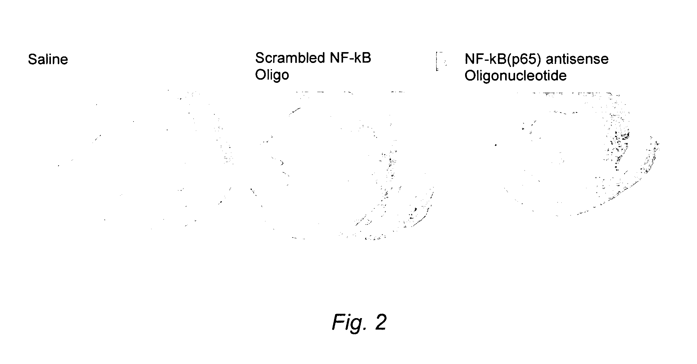 Methods and Compositions for the Treatment or Prevention of Secondary Ischemic Injury