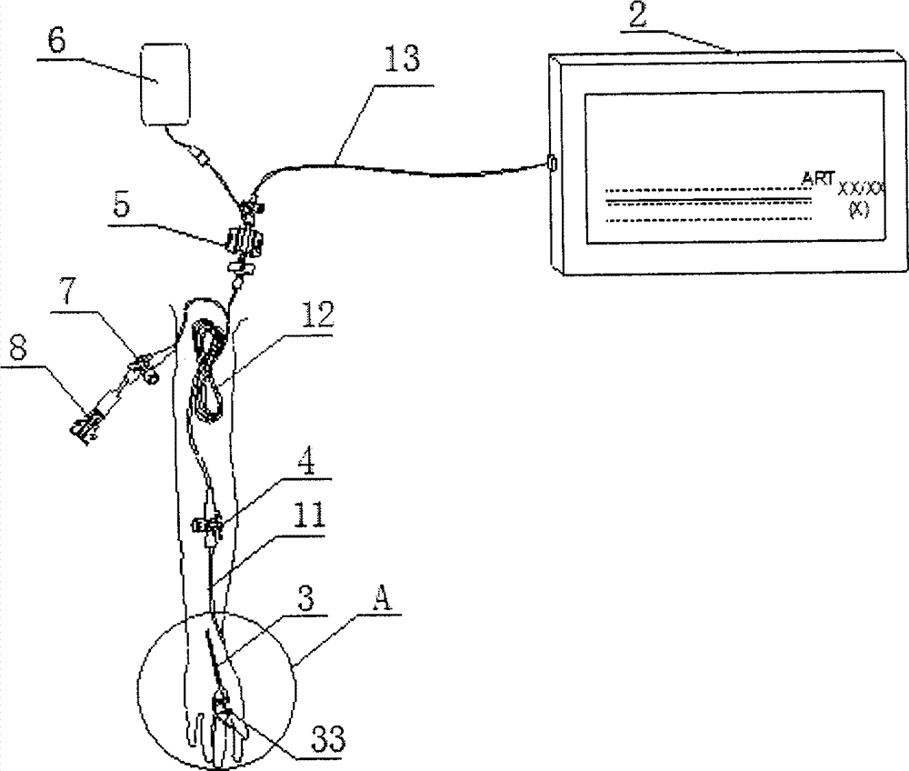 Puncture method of artery puncture needle for invasive arterial blood pressure monitoring