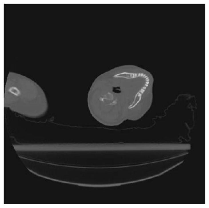 An Automatic Detection and Correction Method of Head Tilt in CT Image