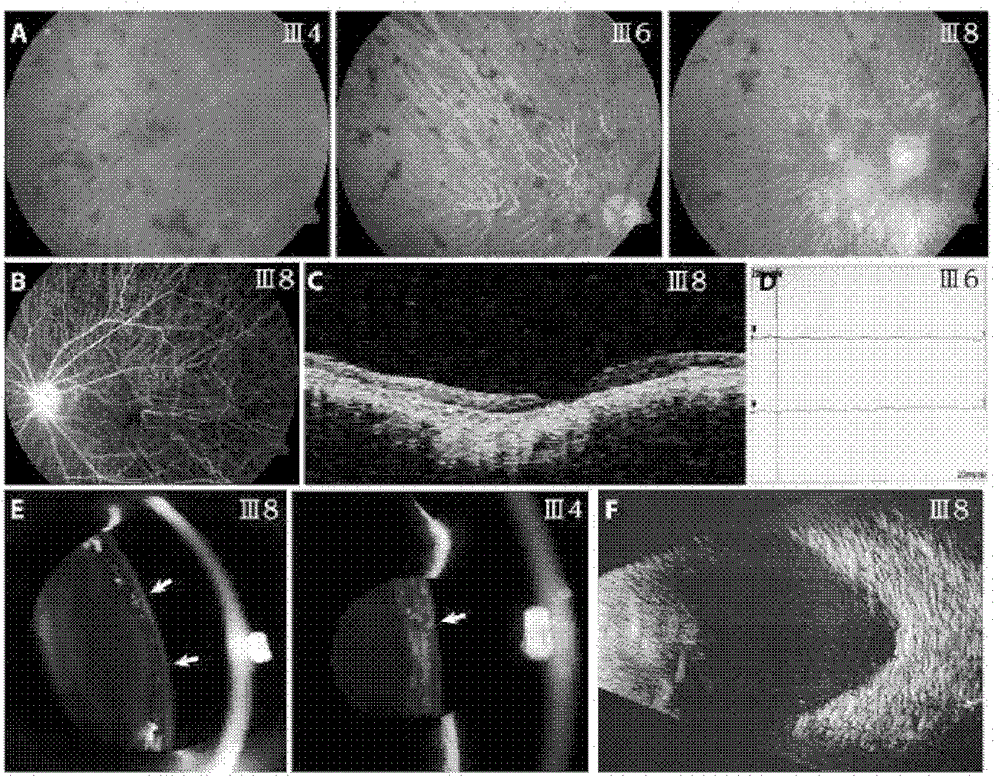 Retinitis pigmentosa related gene identification, and product, method and use thereof