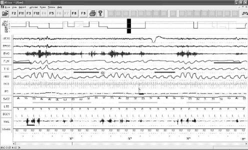 Method for determining severity of obstructive sleep apnea hypopnea syndrome (OSAHS) according to snore acoustic characteristics