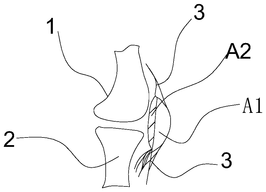 Design method of kneecap prosthesis