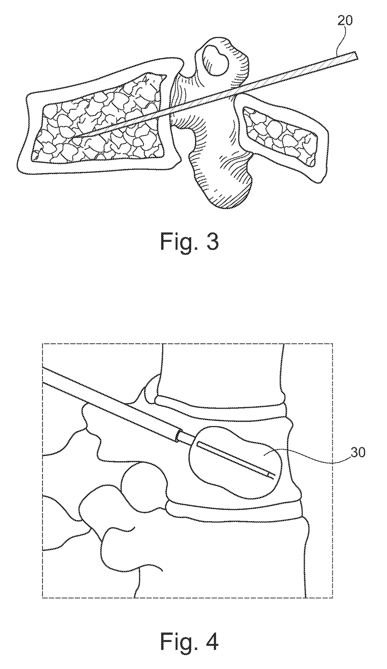 Biocompatible material in granules made of metal material or metal alloys and use of said granules for vertebroplasty