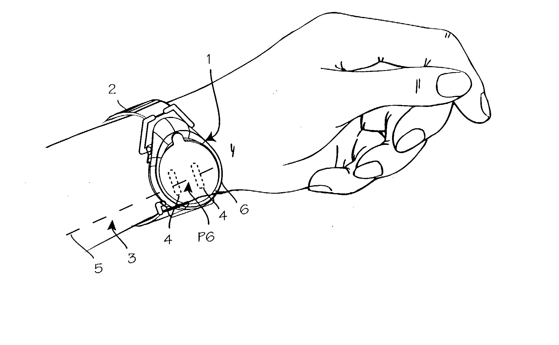 Electro-acupuncture device with stimulation electrode assembly