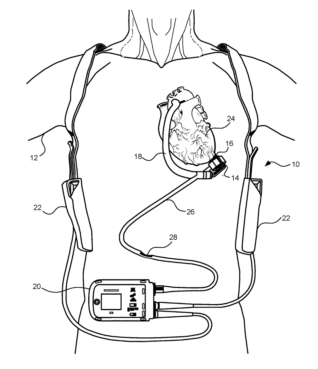 Methods for LVAD operation during communication losses