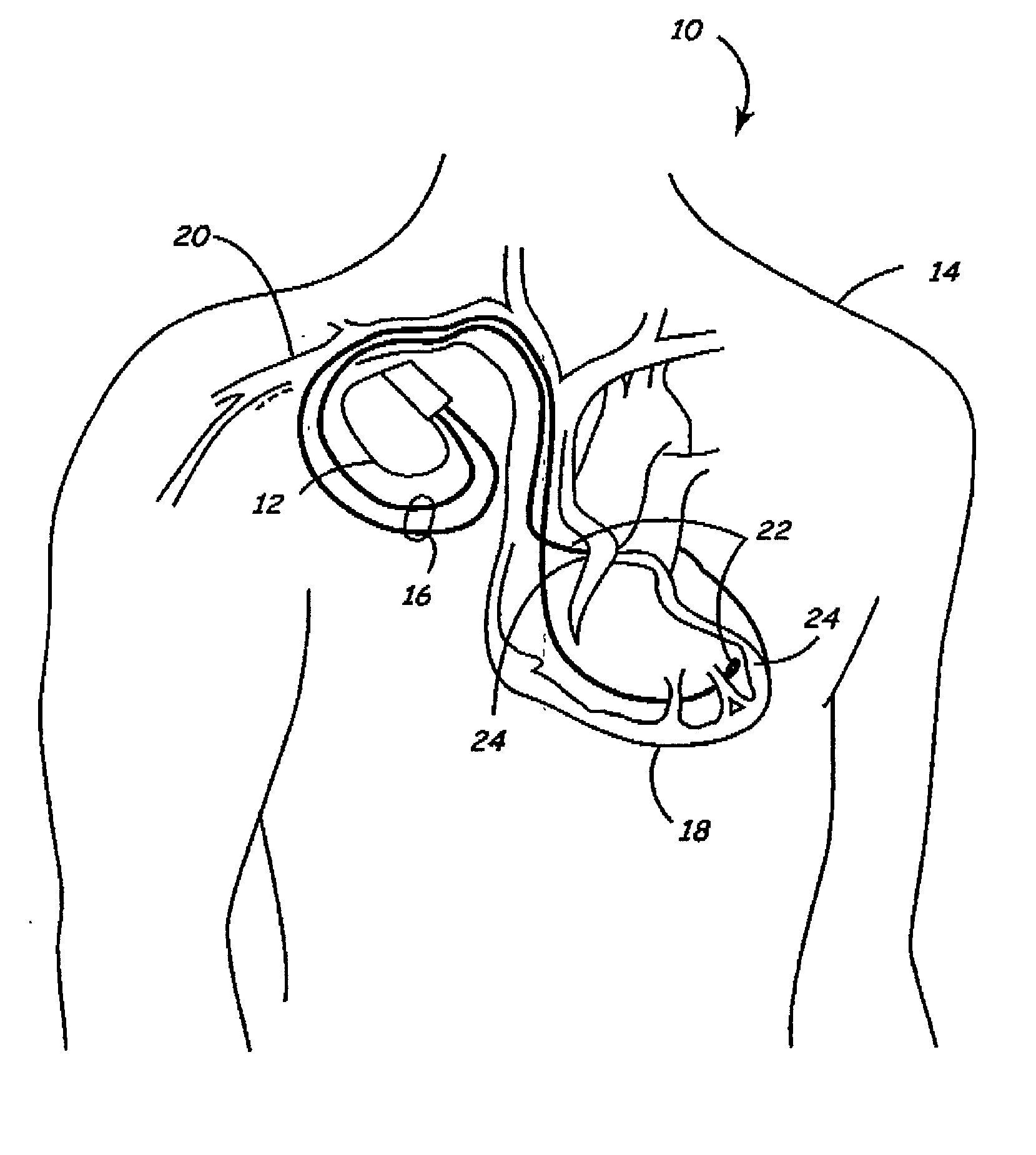 Medical implantable system for reducing magnetic resonance effects