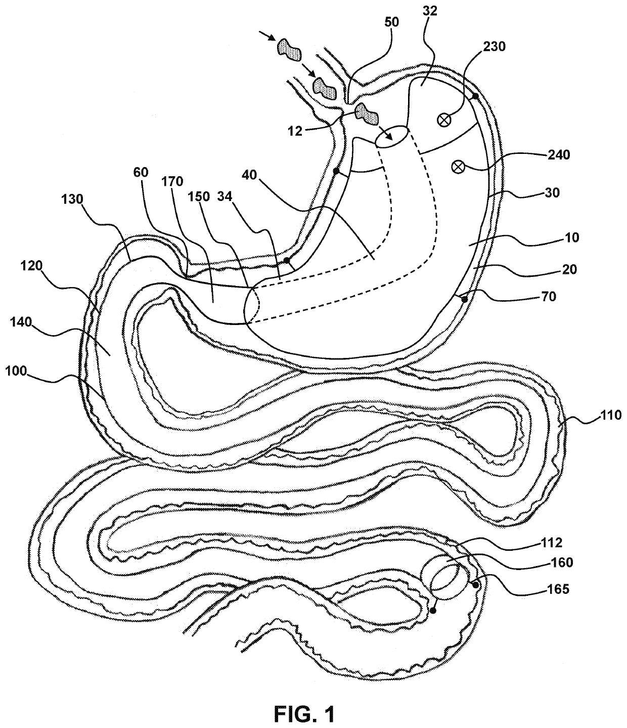 Weight Loss Devices Having Anchor-Free Regions