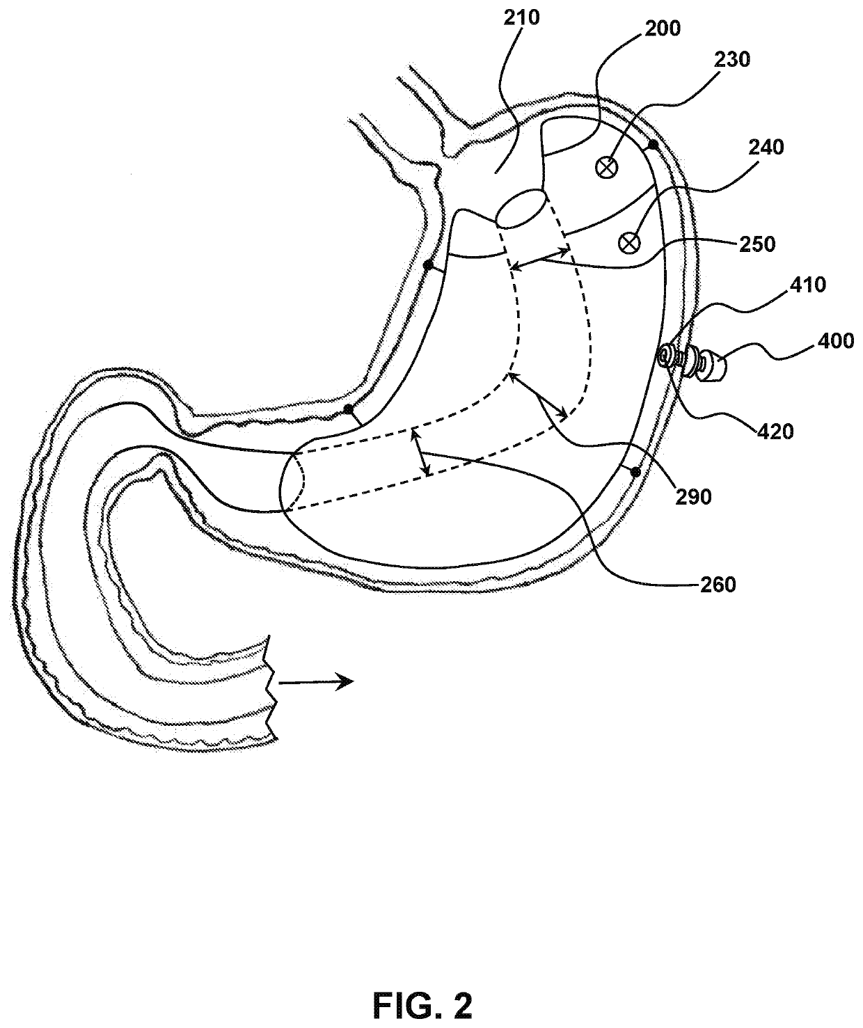 Weight Loss Devices Having Anchor-Free Regions