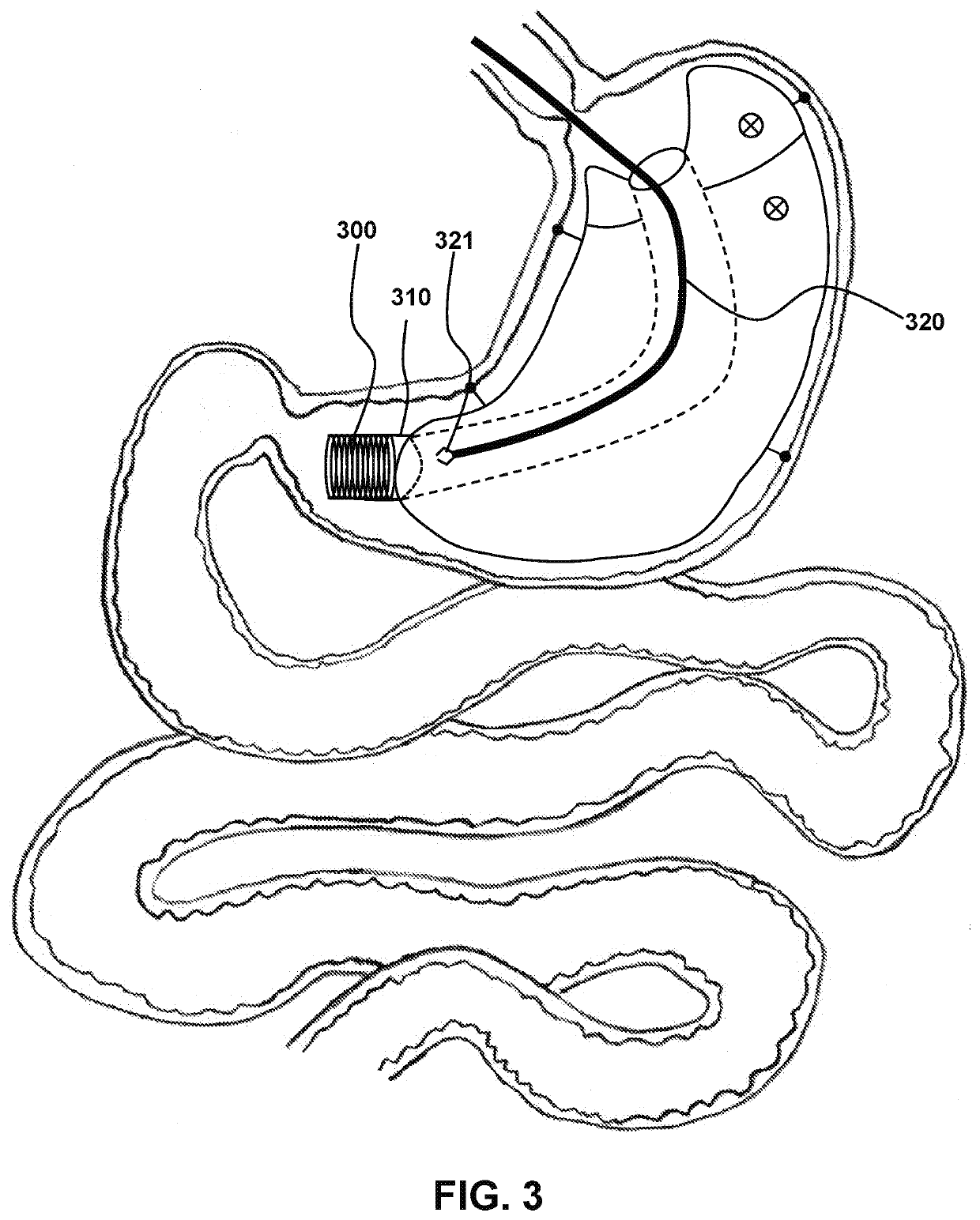 Weight Loss Devices Having Anchor-Free Regions