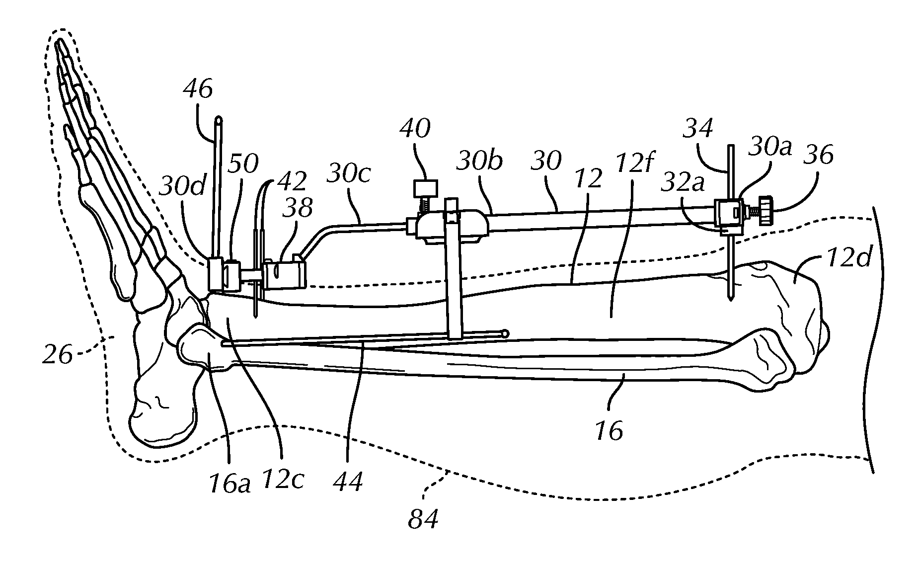 Surgical instrumentation and methods of use for implanting a prosthesis