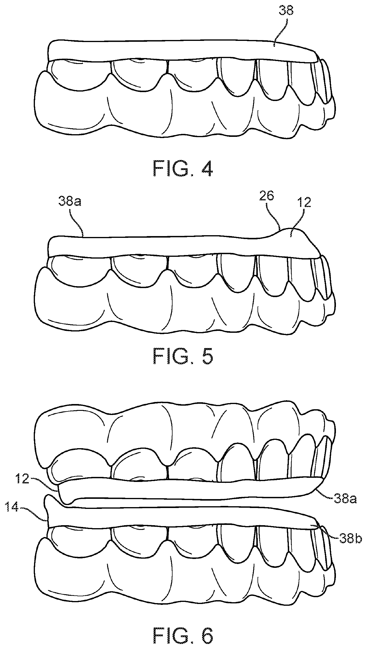 Combined orthodontic movement of teeth with airway development therapy