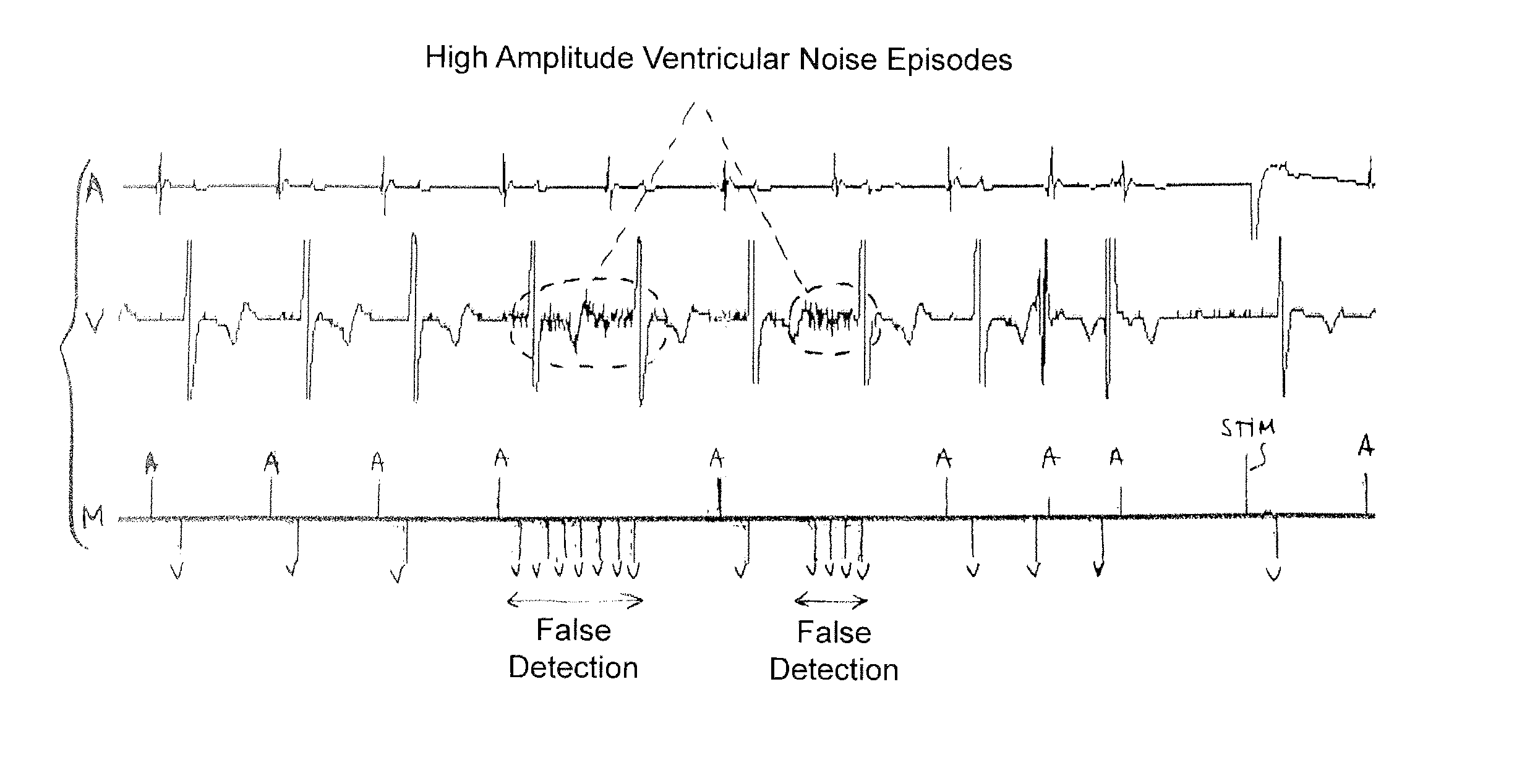 Implantable defibrillator/cardioverter medical device with a dynamically adjustable threshold for ventricular detection