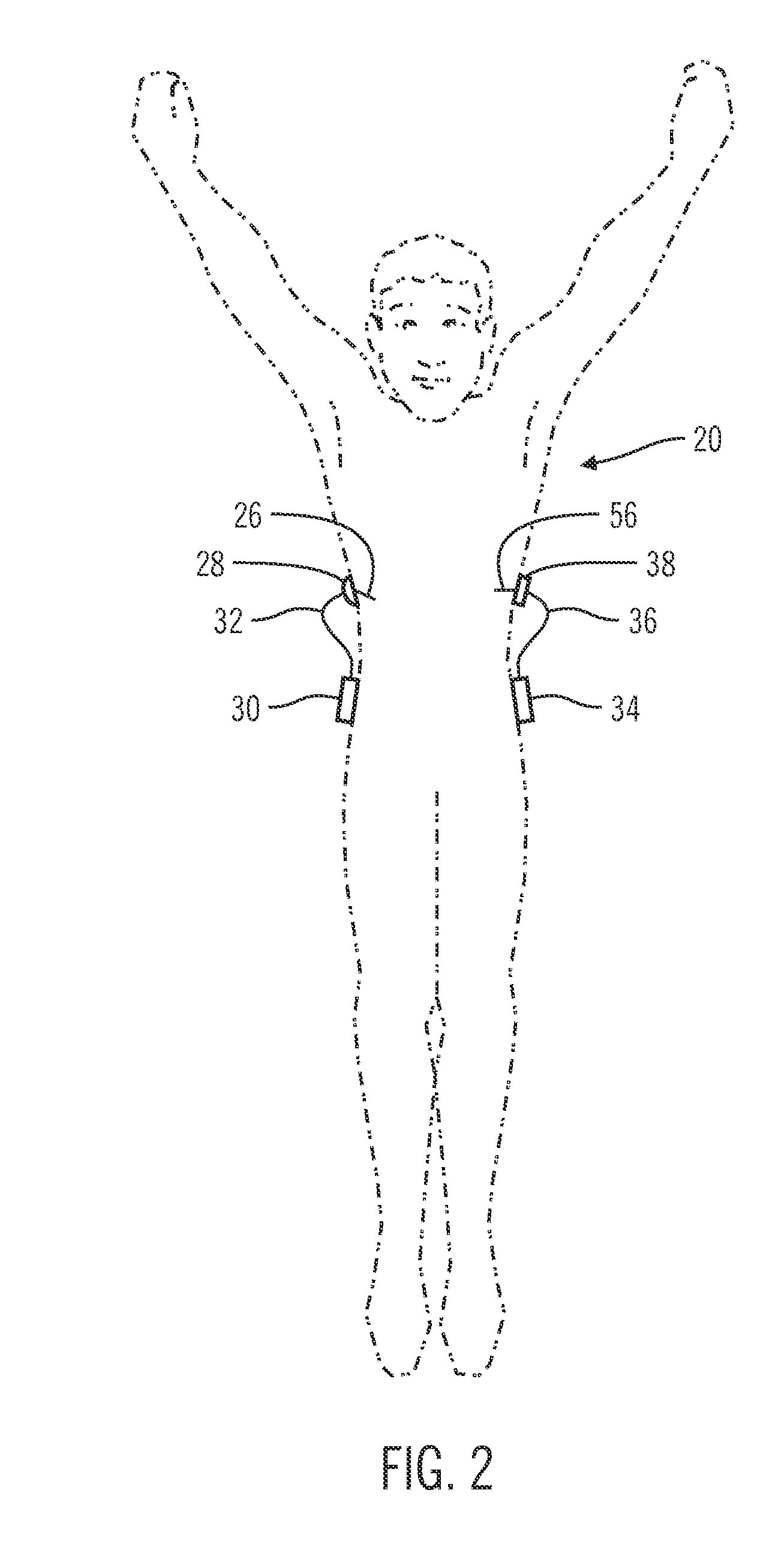 Insulin on board compensation for a closed-loop insulin infusion system