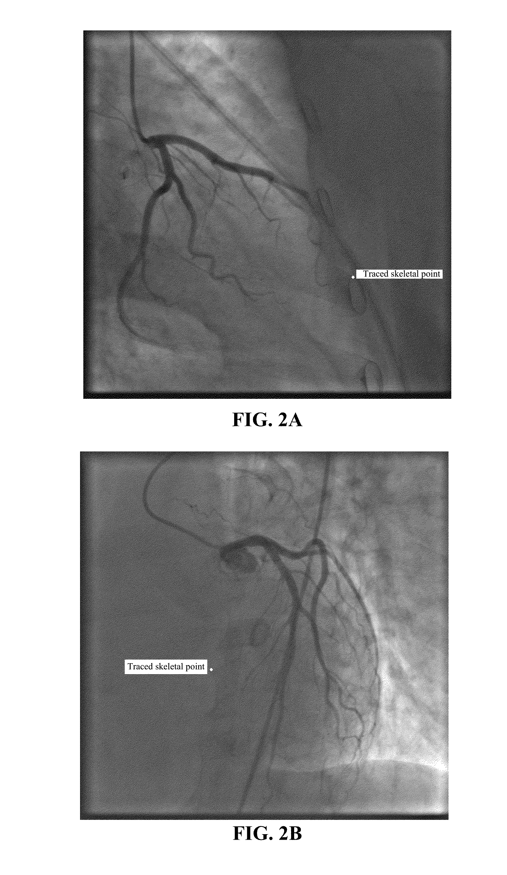 Method for separating and estimating multiple motion parameters in x-ray angiogram image