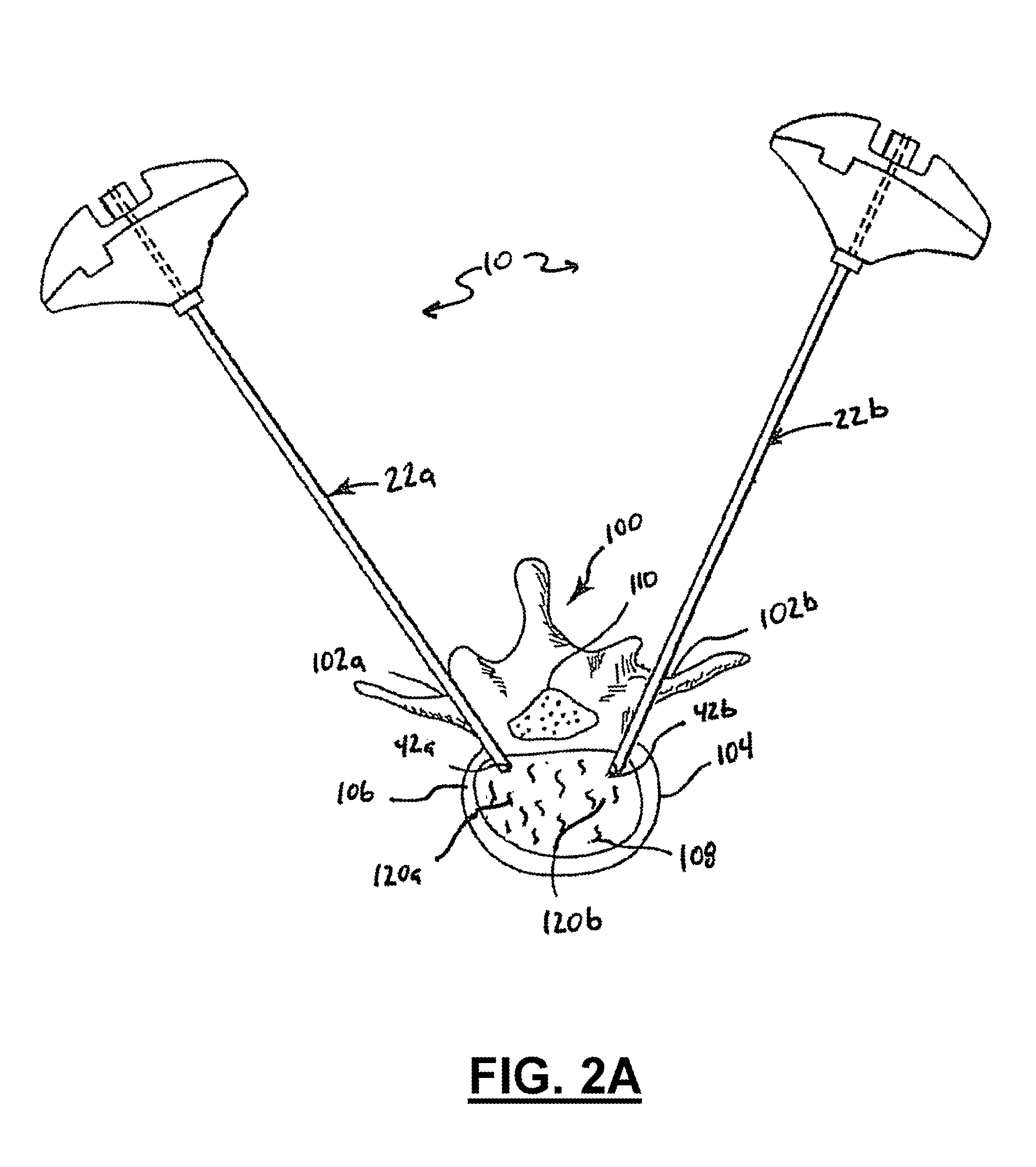 Apparatus and method for stylet-guided vertebral augmentation