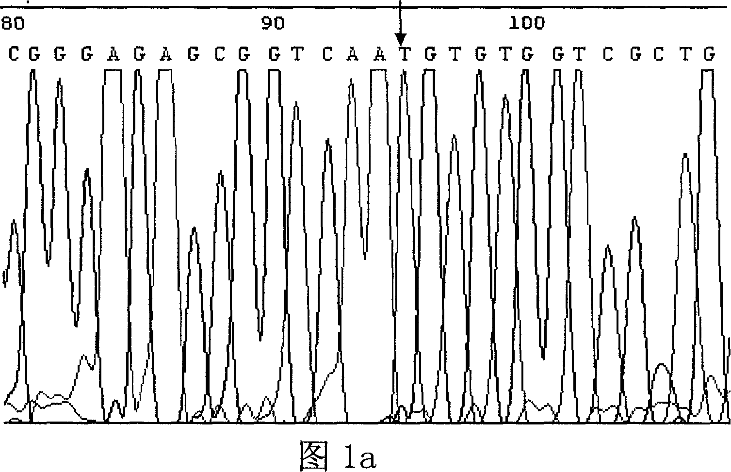 Method for determining patient's brain ictus genetic susceptibility