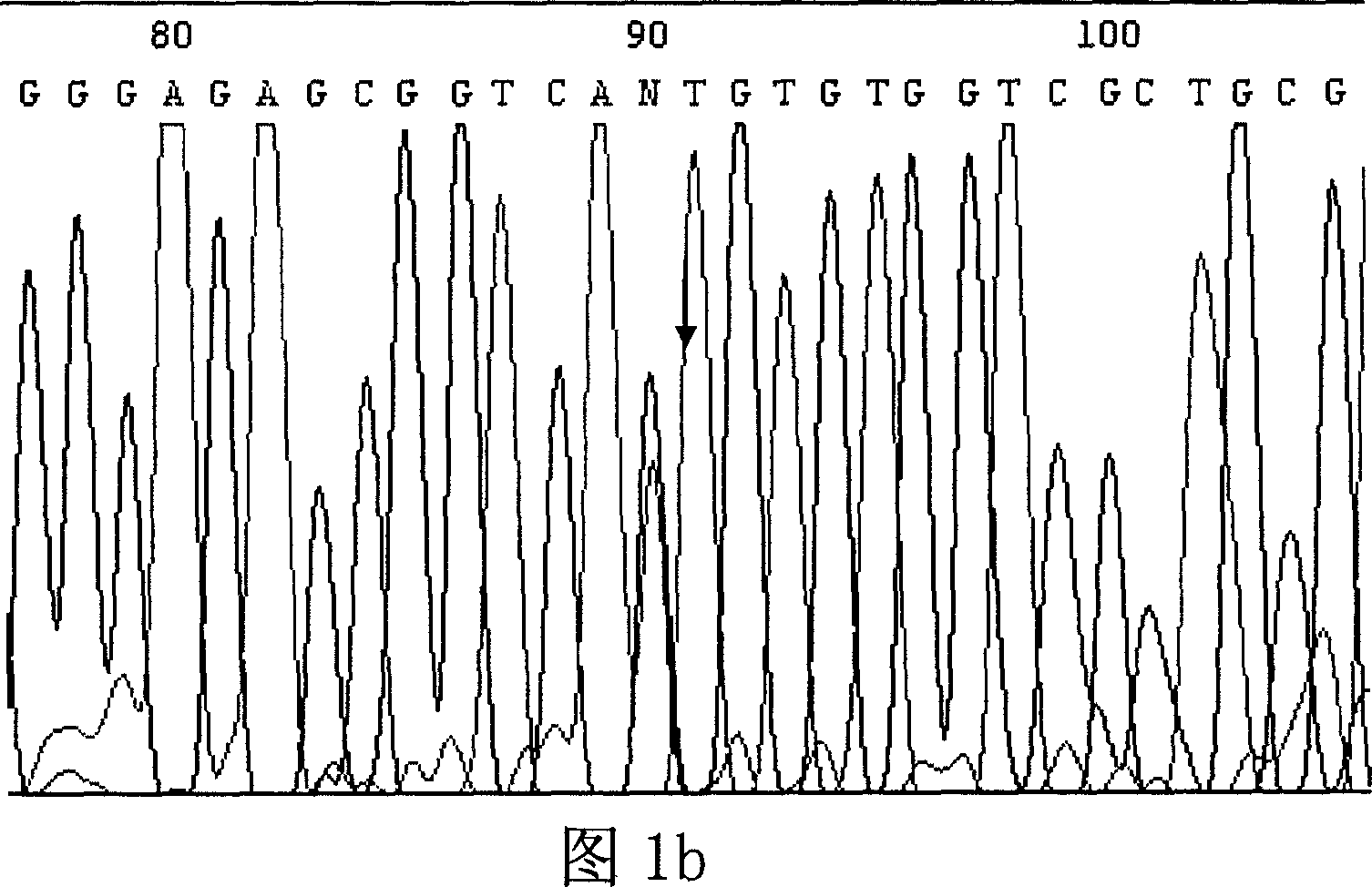 Method for determining patient's brain ictus genetic susceptibility