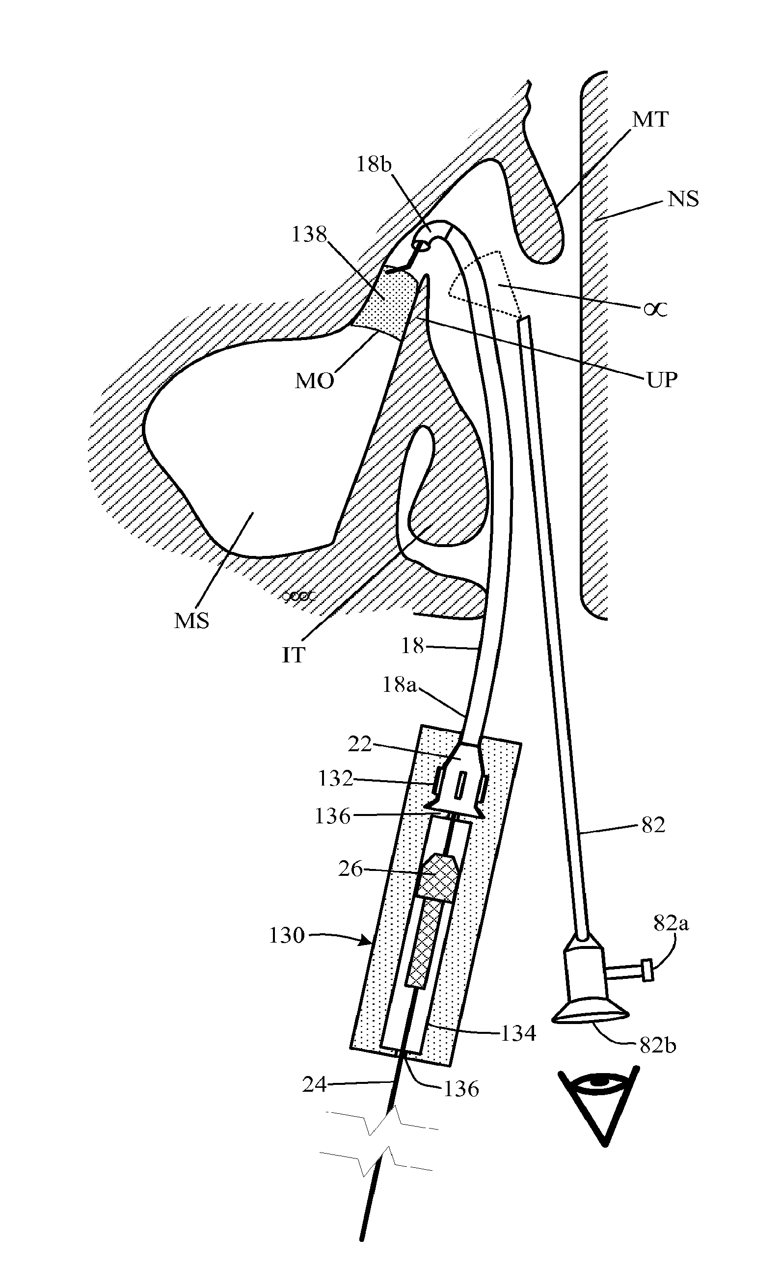 Guide catheter and method of use