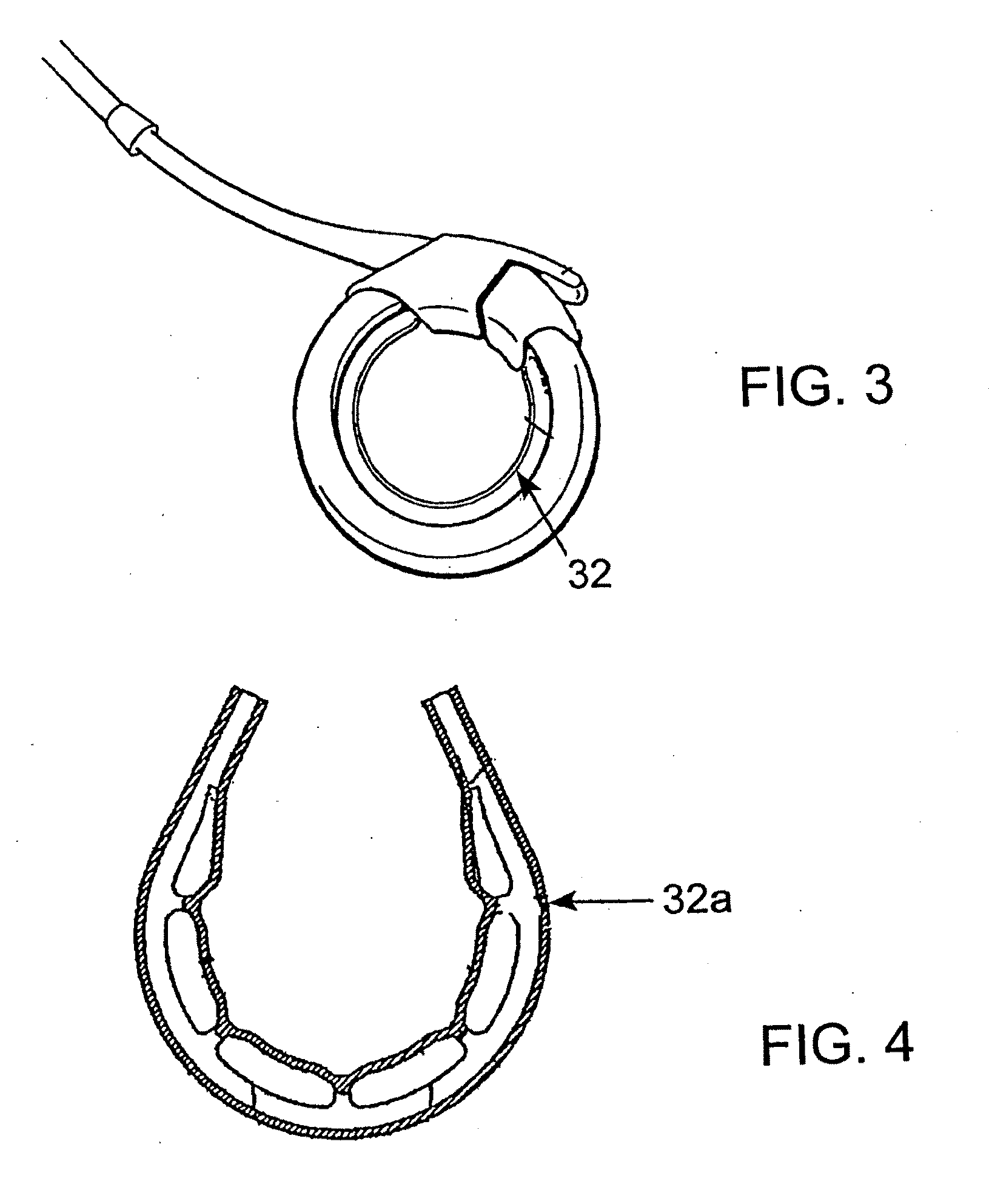 Releasably-securable one-piece adjustable gastric band