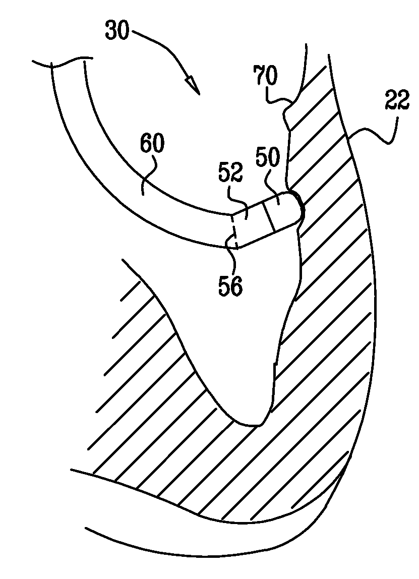 Catheter display showing tip angle and pressure