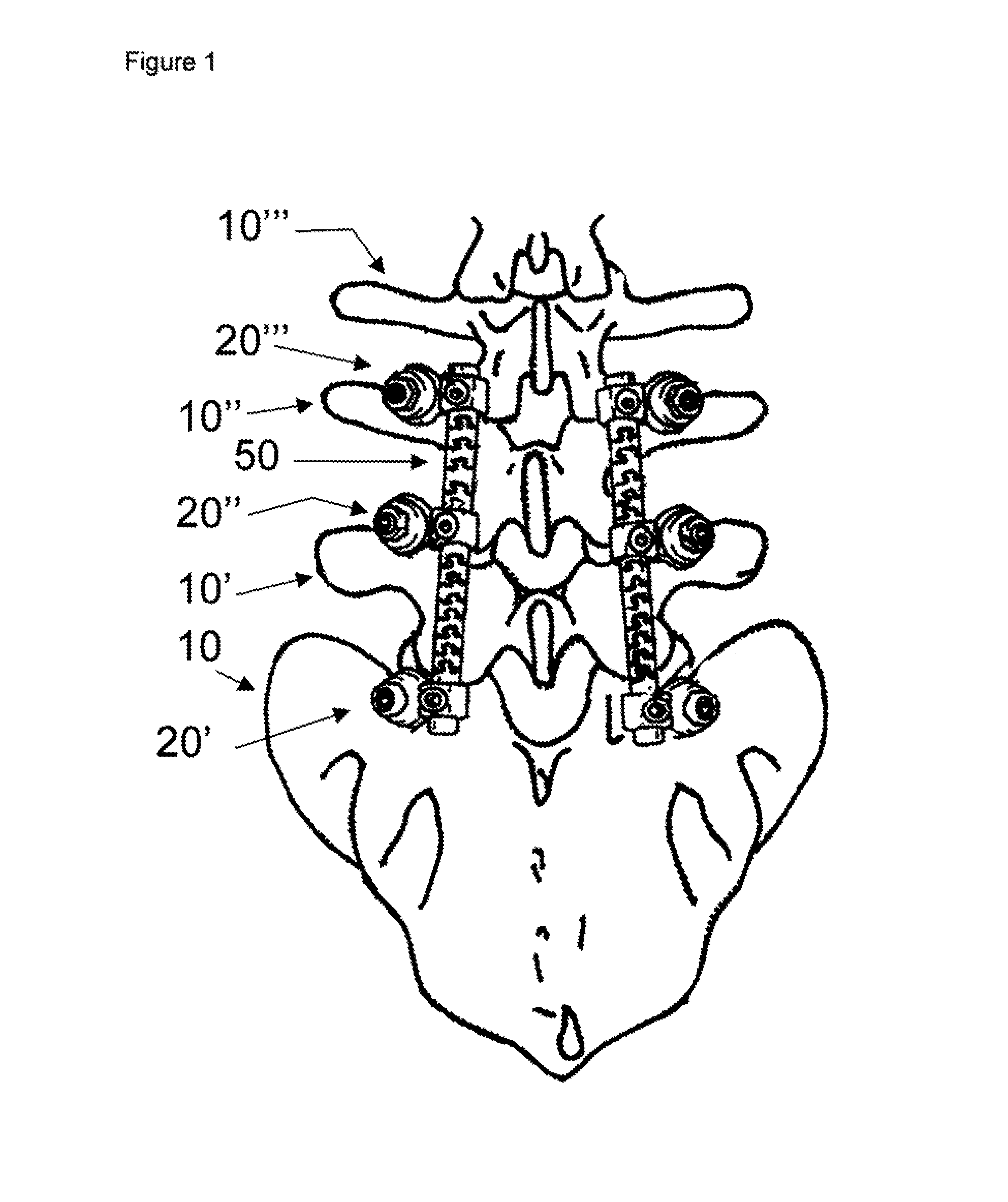 Flexible spine components having a concentric slot