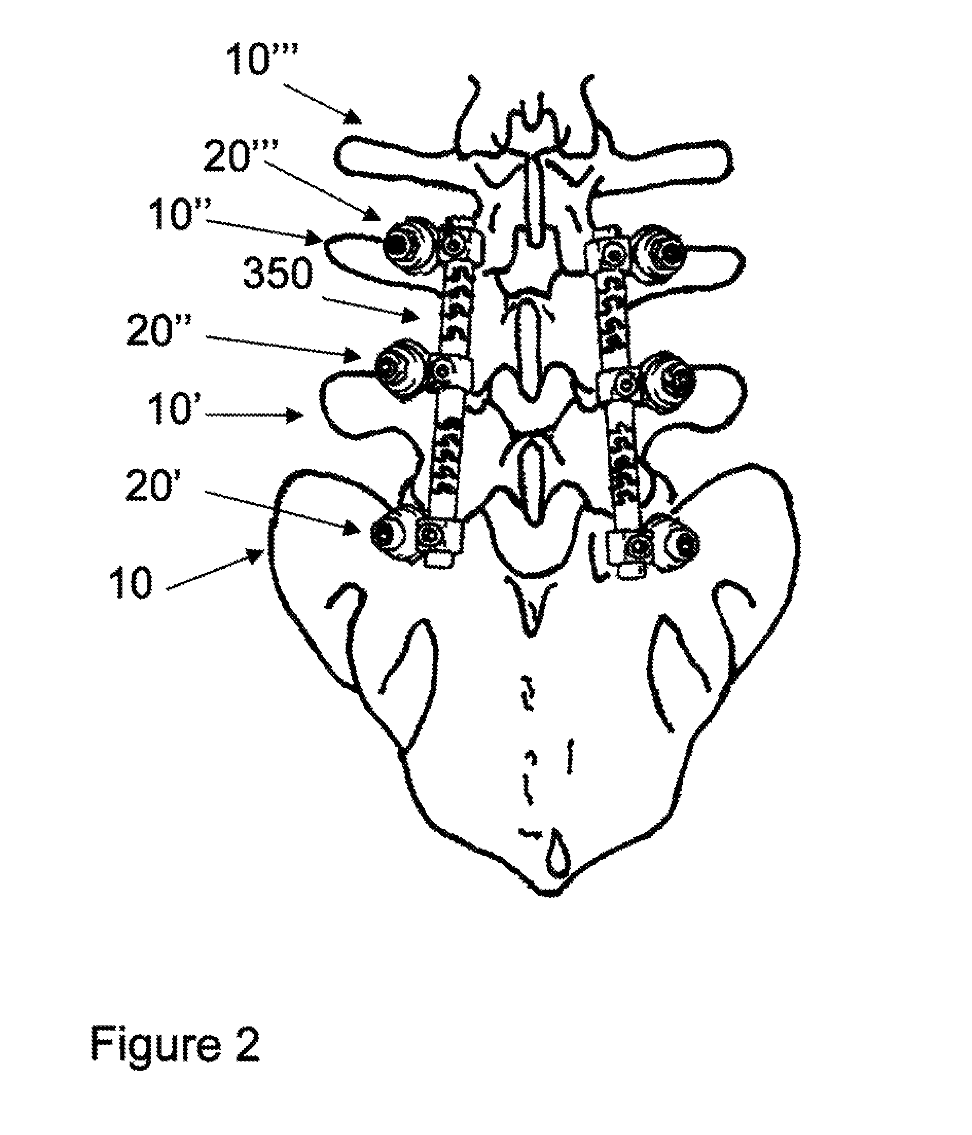 Flexible spine components having a concentric slot