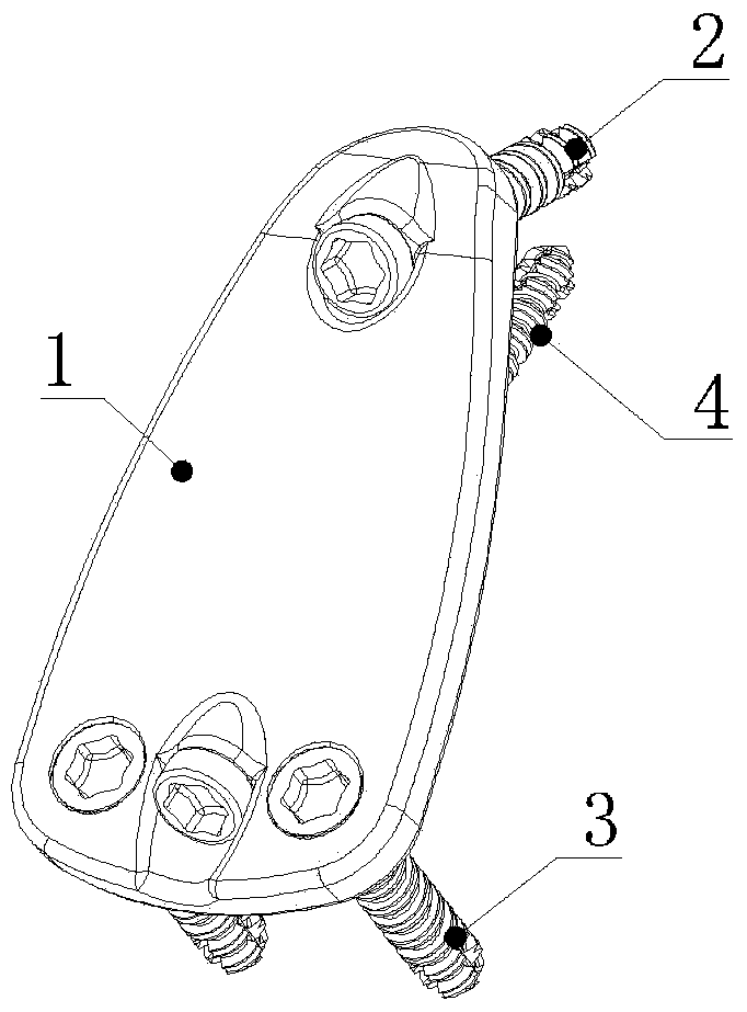 A Cervical 2‑3 Anterior Reduction Plate System