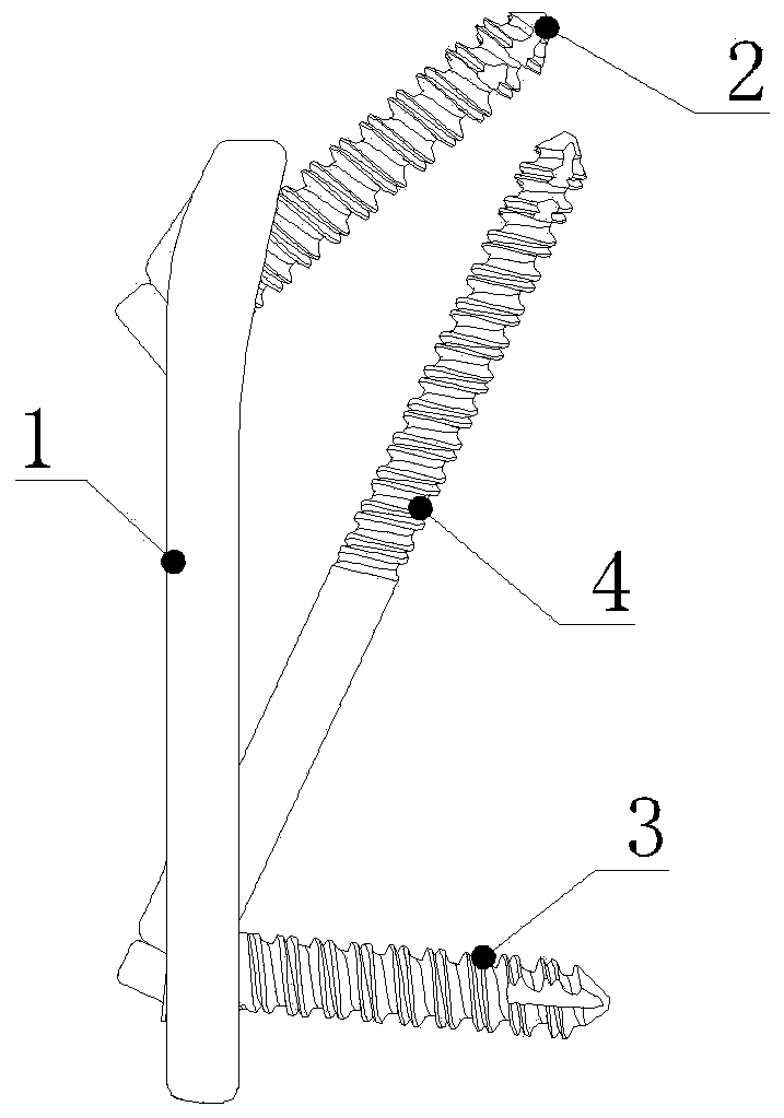 A Cervical 2‑3 Anterior Reduction Plate System