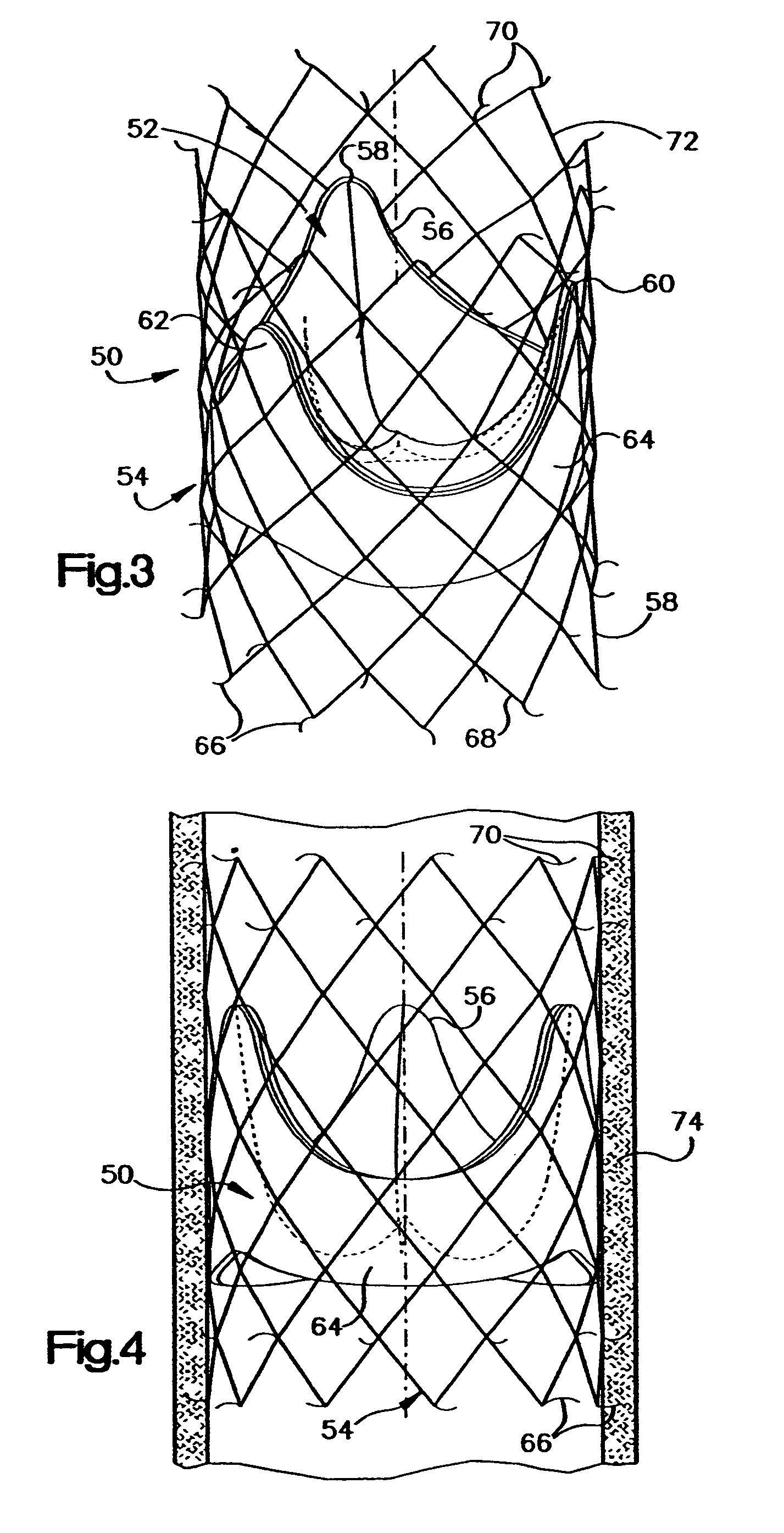 Implantation system for delivery of a heart valve prosthesis