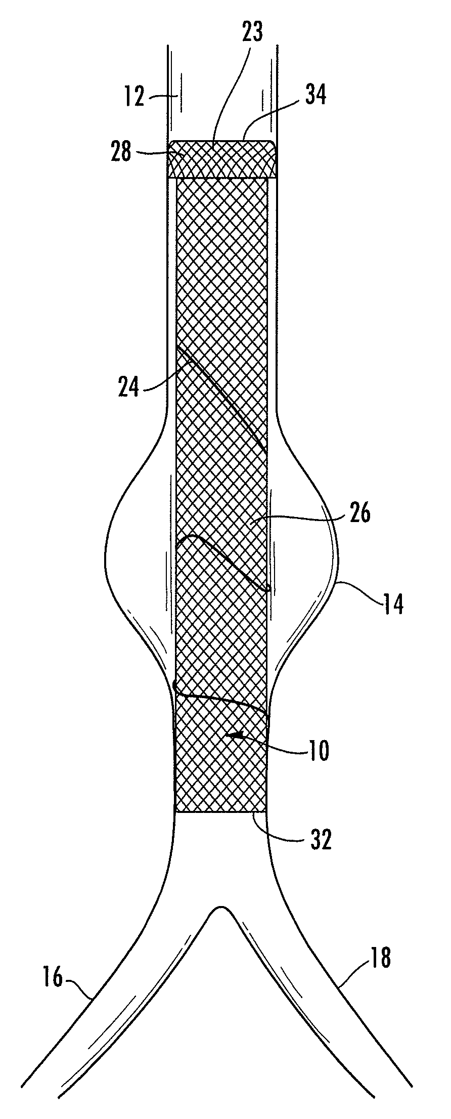 Stent graft for reinforcement of vascular abnormalities and associated method