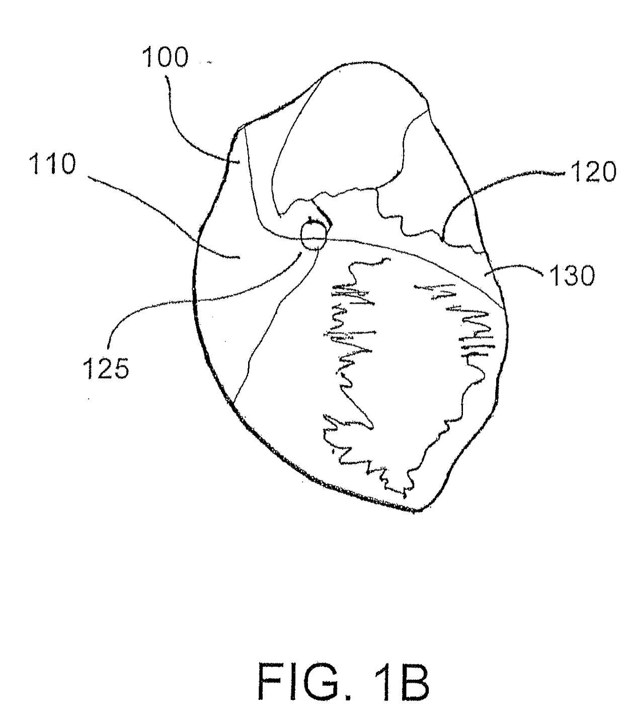 Engagement catheter devices, systems, and methods to use the same under suctional tissue engagement