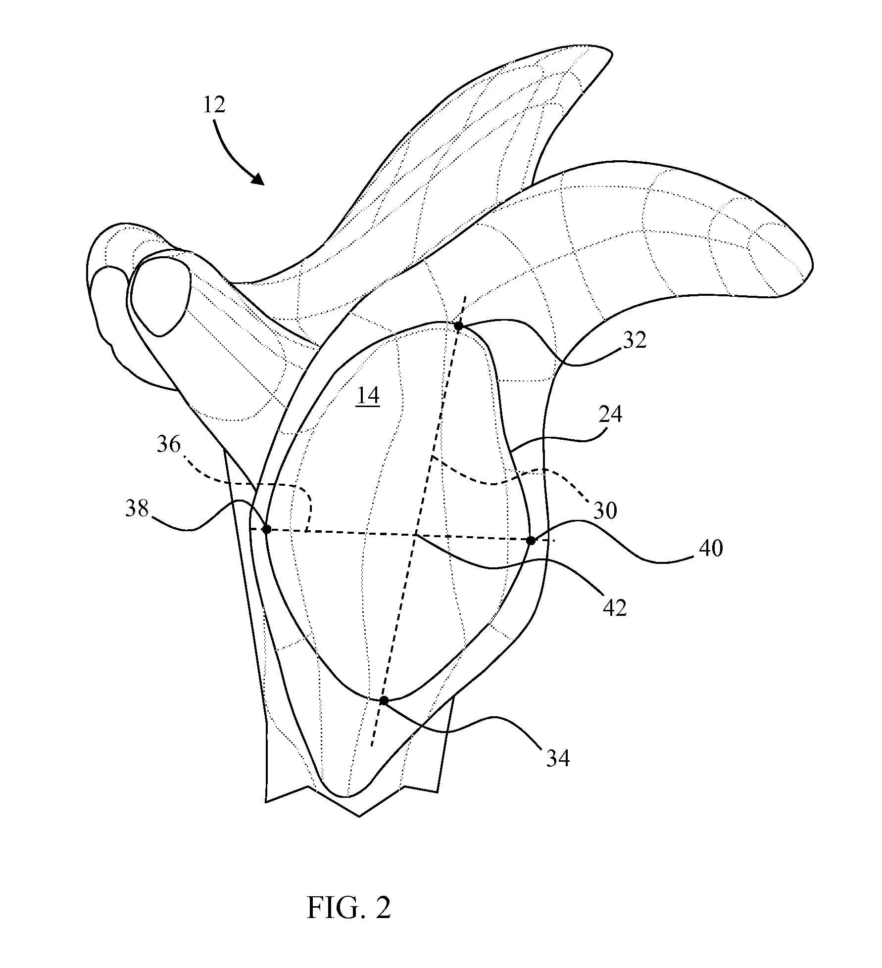 Revision glenoid device and method