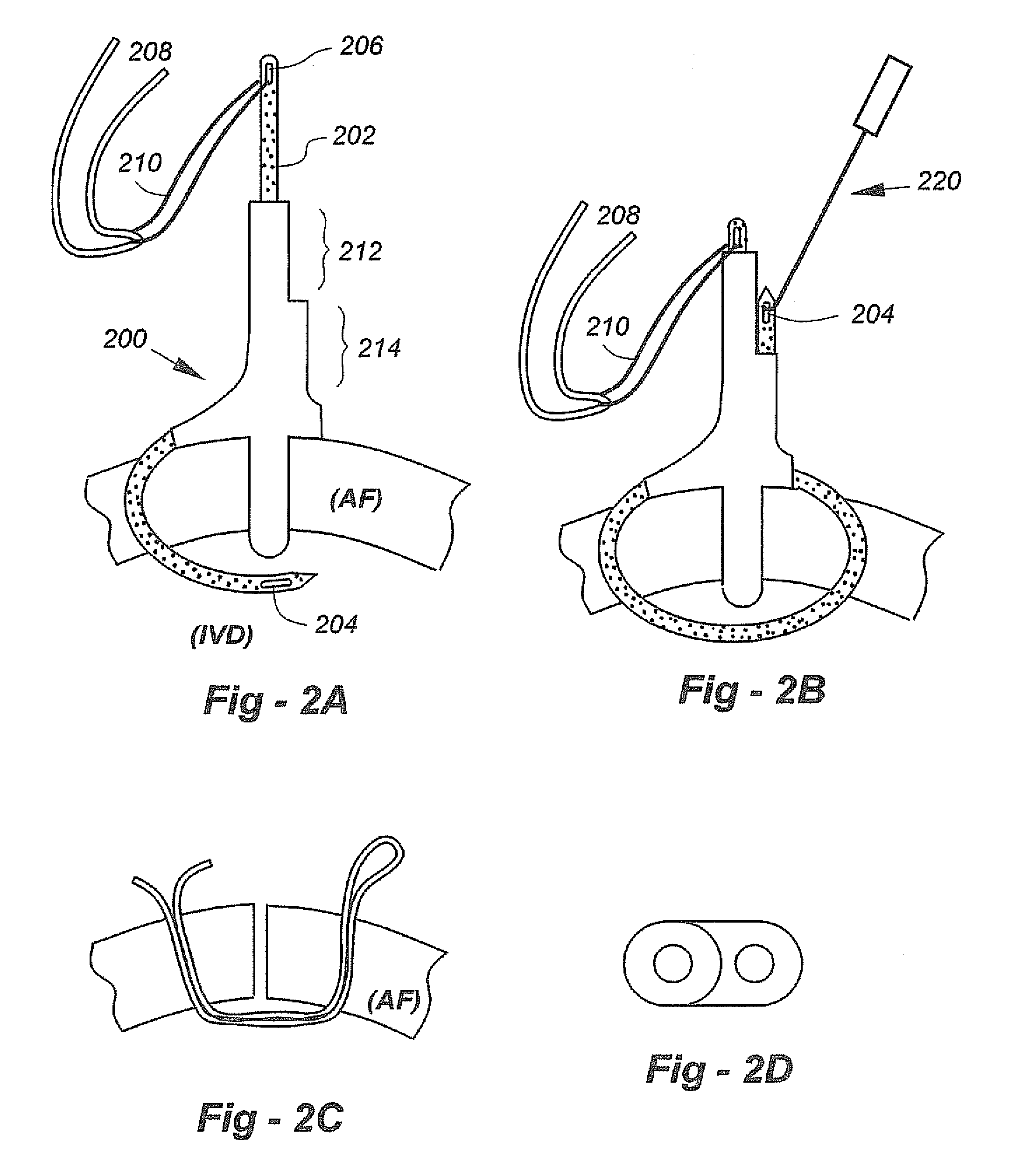 Soft tissue repair methods and apparatus