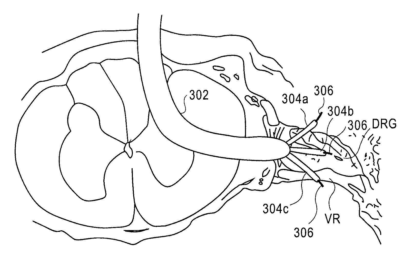 Expandable stimulation leads and methods of use
