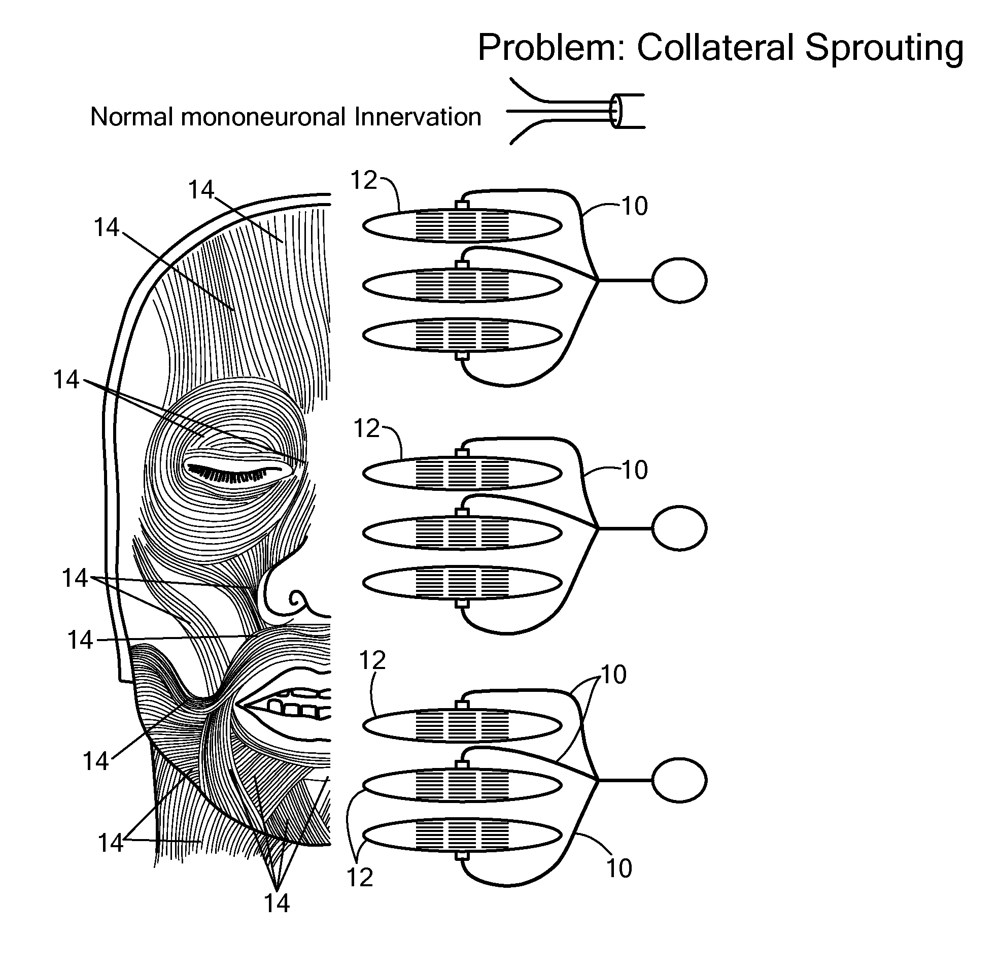 System and method for facial nerve stimulation