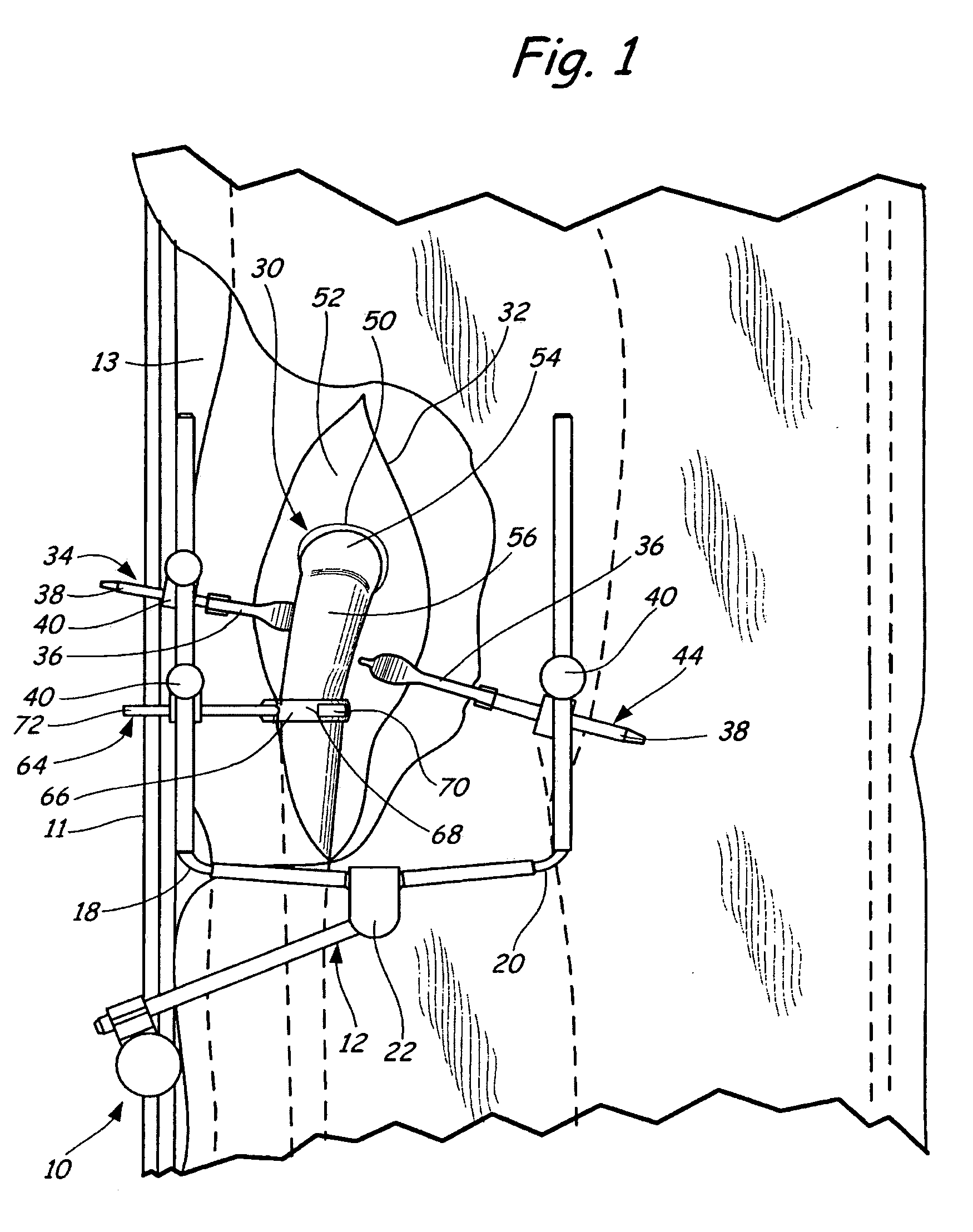 Method of table mounted retraction in hip surgery and surgical retractor
