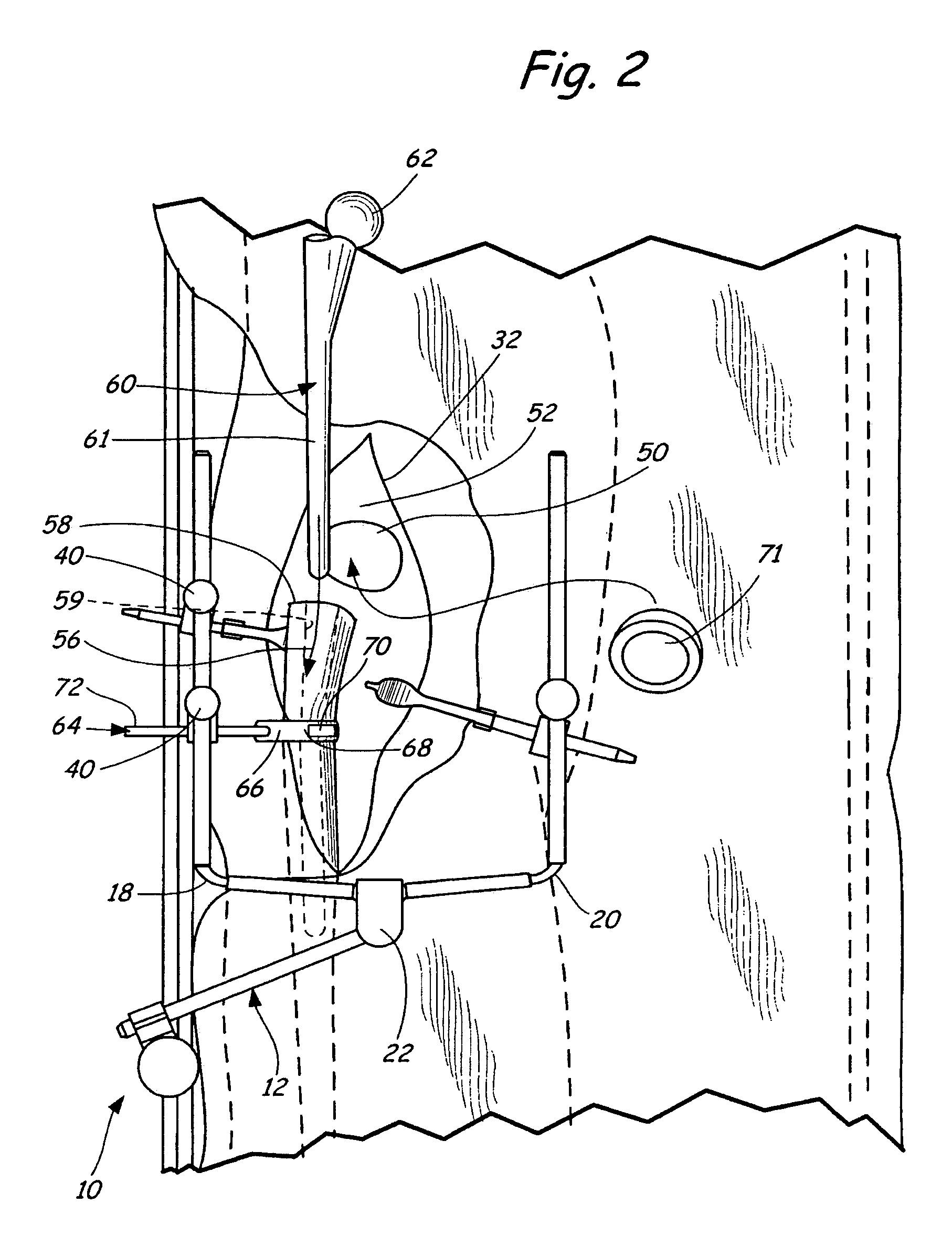 Method of table mounted retraction in hip surgery and surgical retractor
