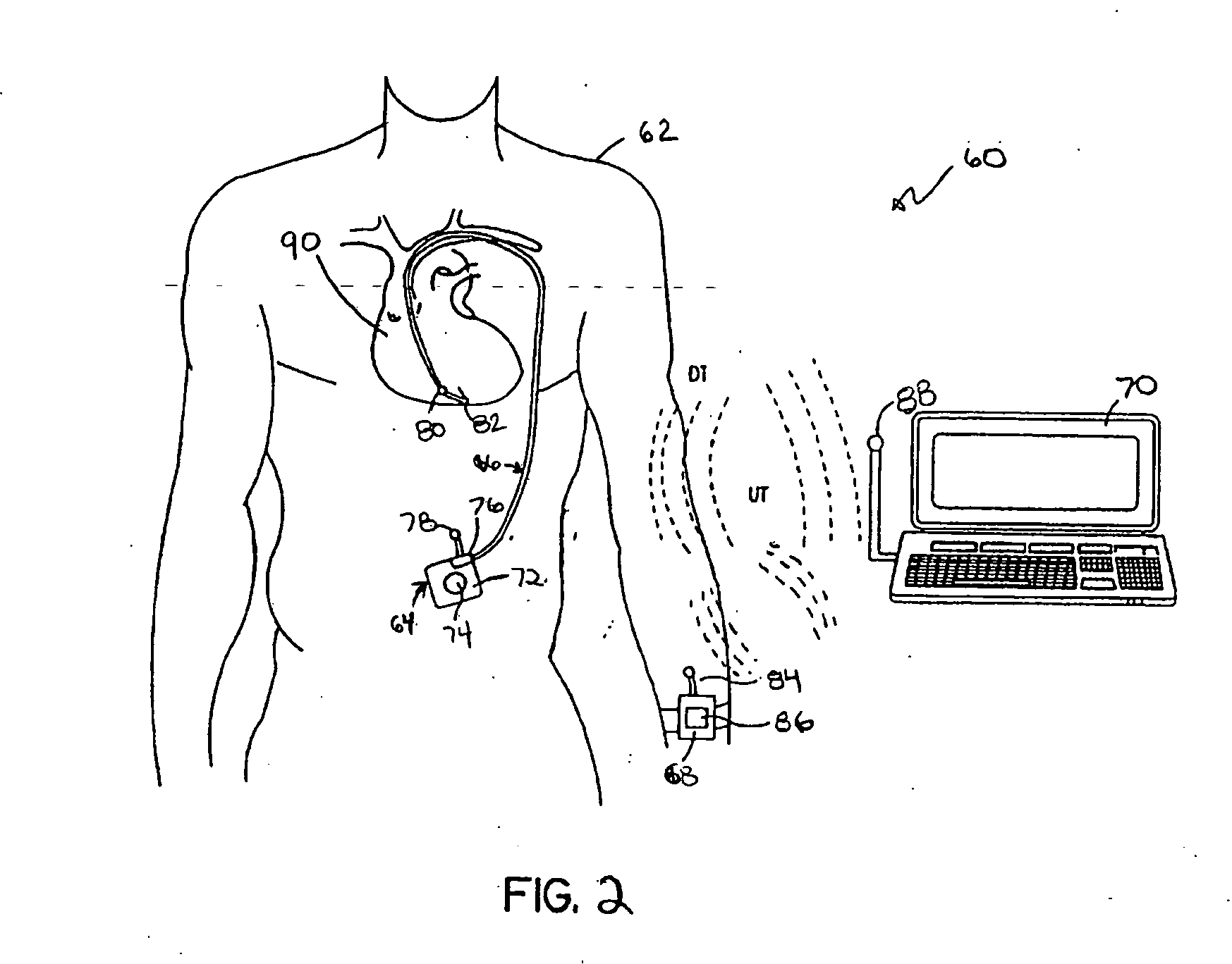 System and method for monitoring a ventricular pressure index to predict worsening heart failure
