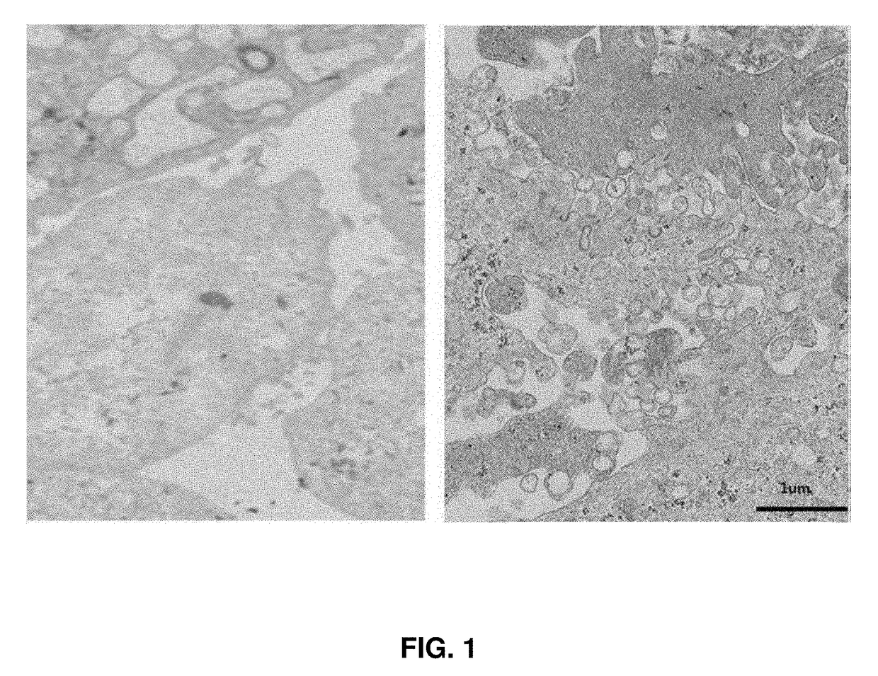 Method for treating an inflammatory brain disease comprising administering a stem cell-derived exosome