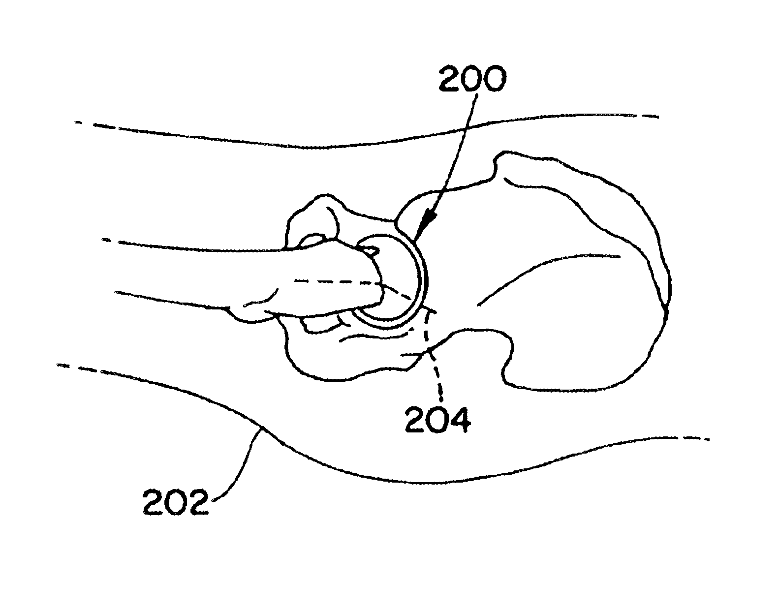 Posterior retractor and method of use for minimally invasive hip surgery