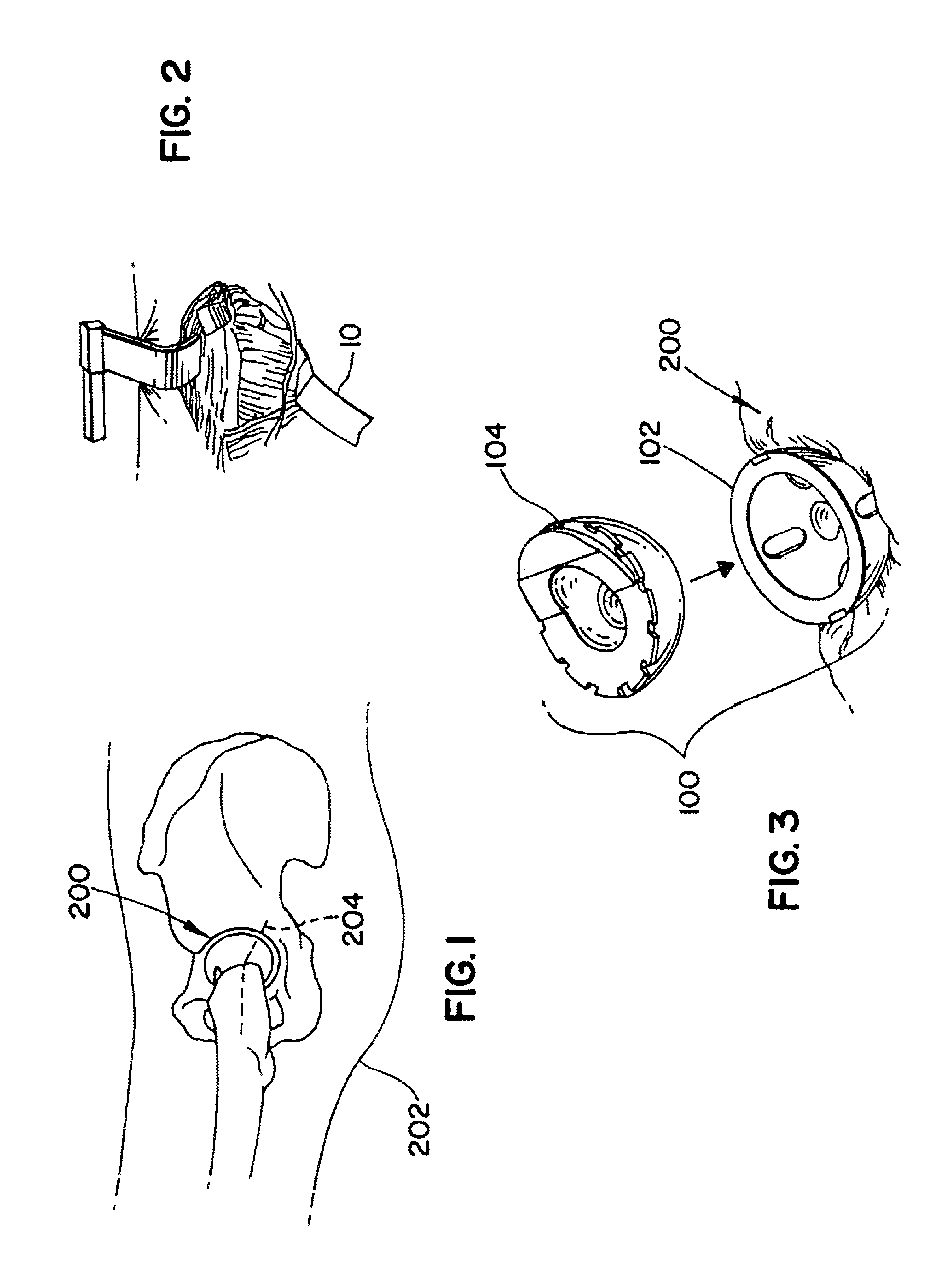 Posterior retractor and method of use for minimally invasive hip surgery