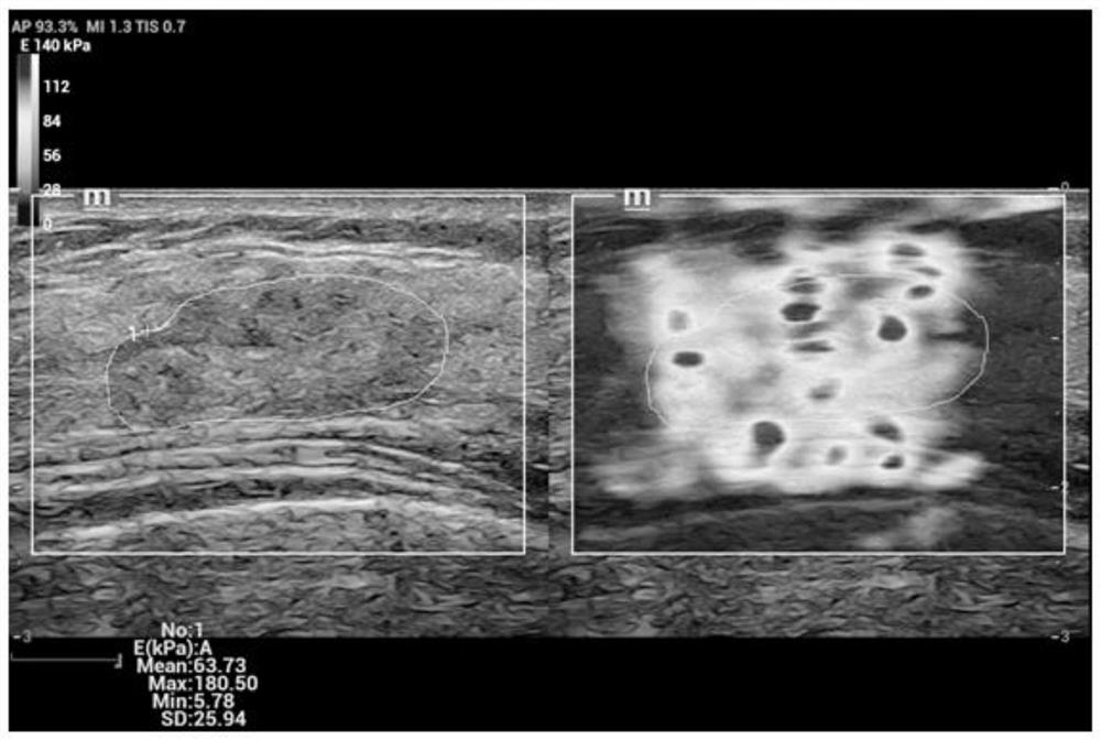 Method for identifying benign and malignant breast nodules based on shear wave elastic diagram of deep learning