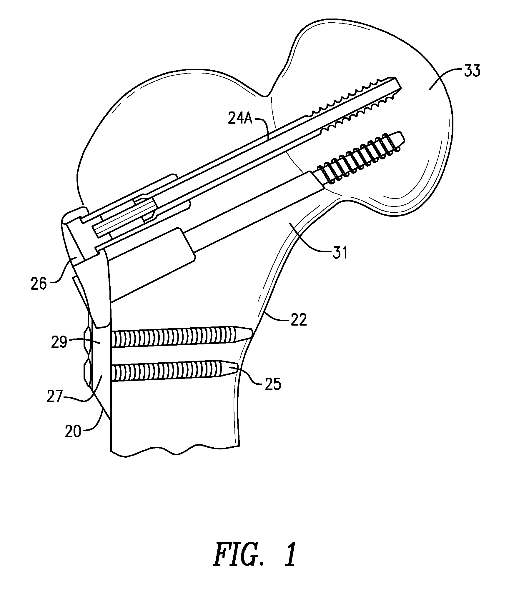 Hip fracture device with static locking mechanism allowing compression