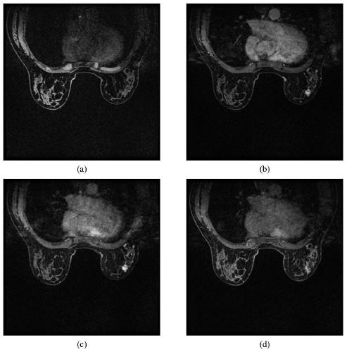 Mammary gland DCE-MRI image lesion segmentation model establishment based on hybrid convolution and segmentation method