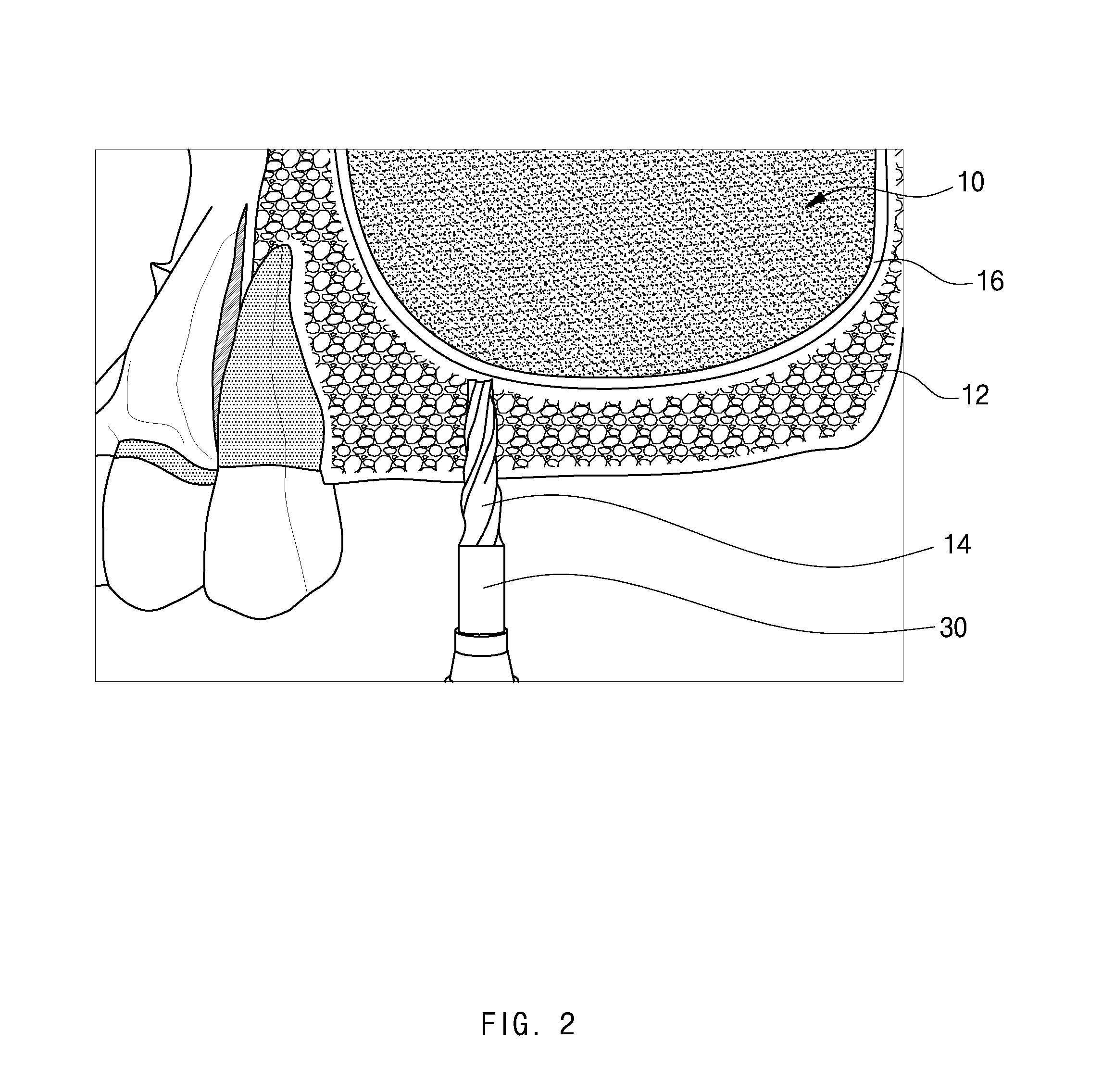Method of maxillary sinus bone grafting for placement of implant