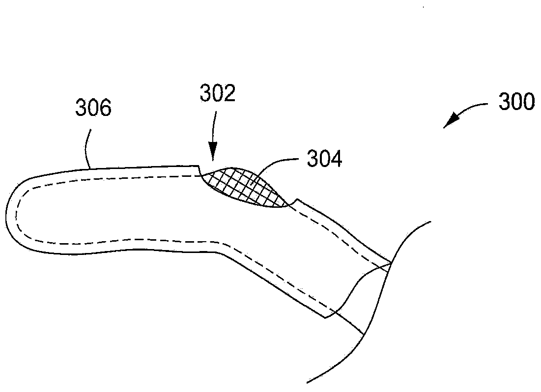 Glove having injection molded components
