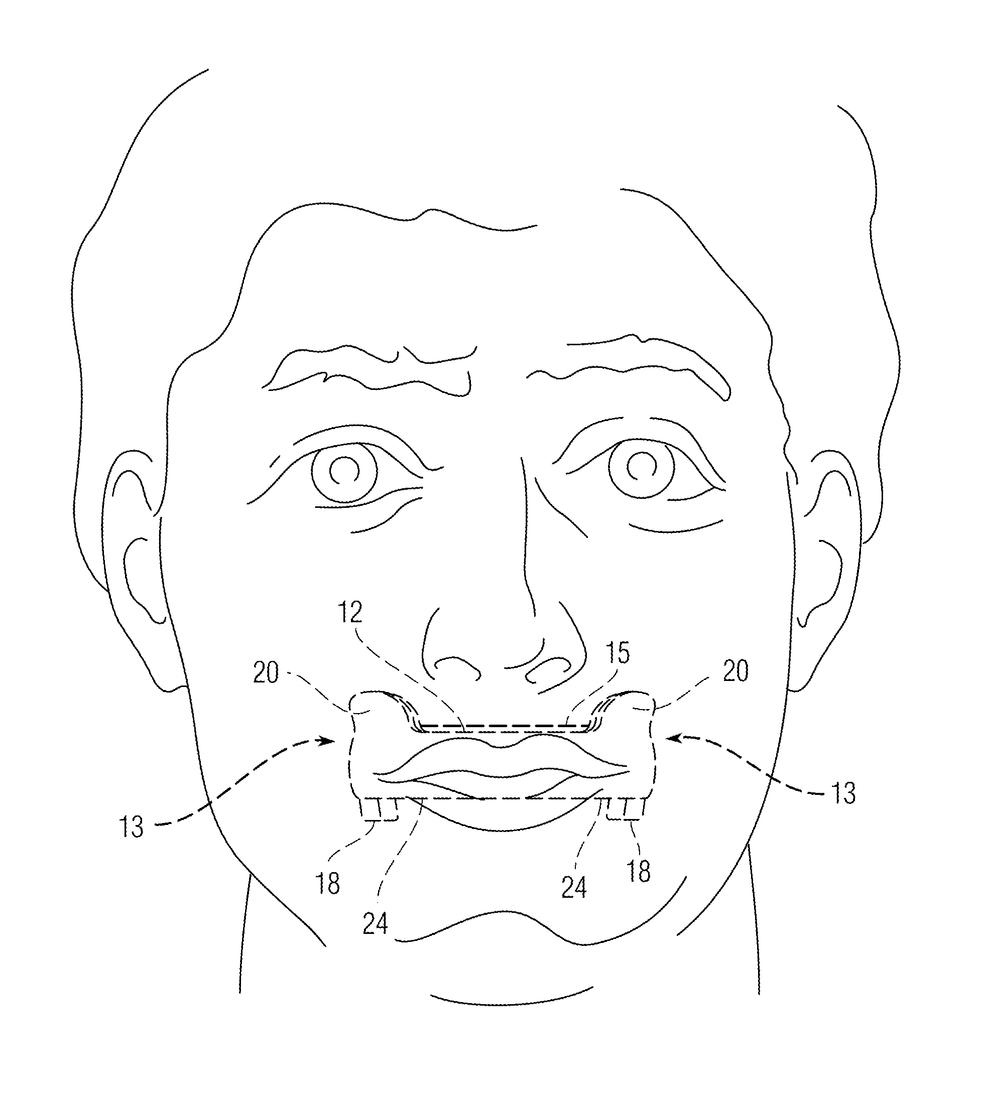 Facial sculpturing dental appliance