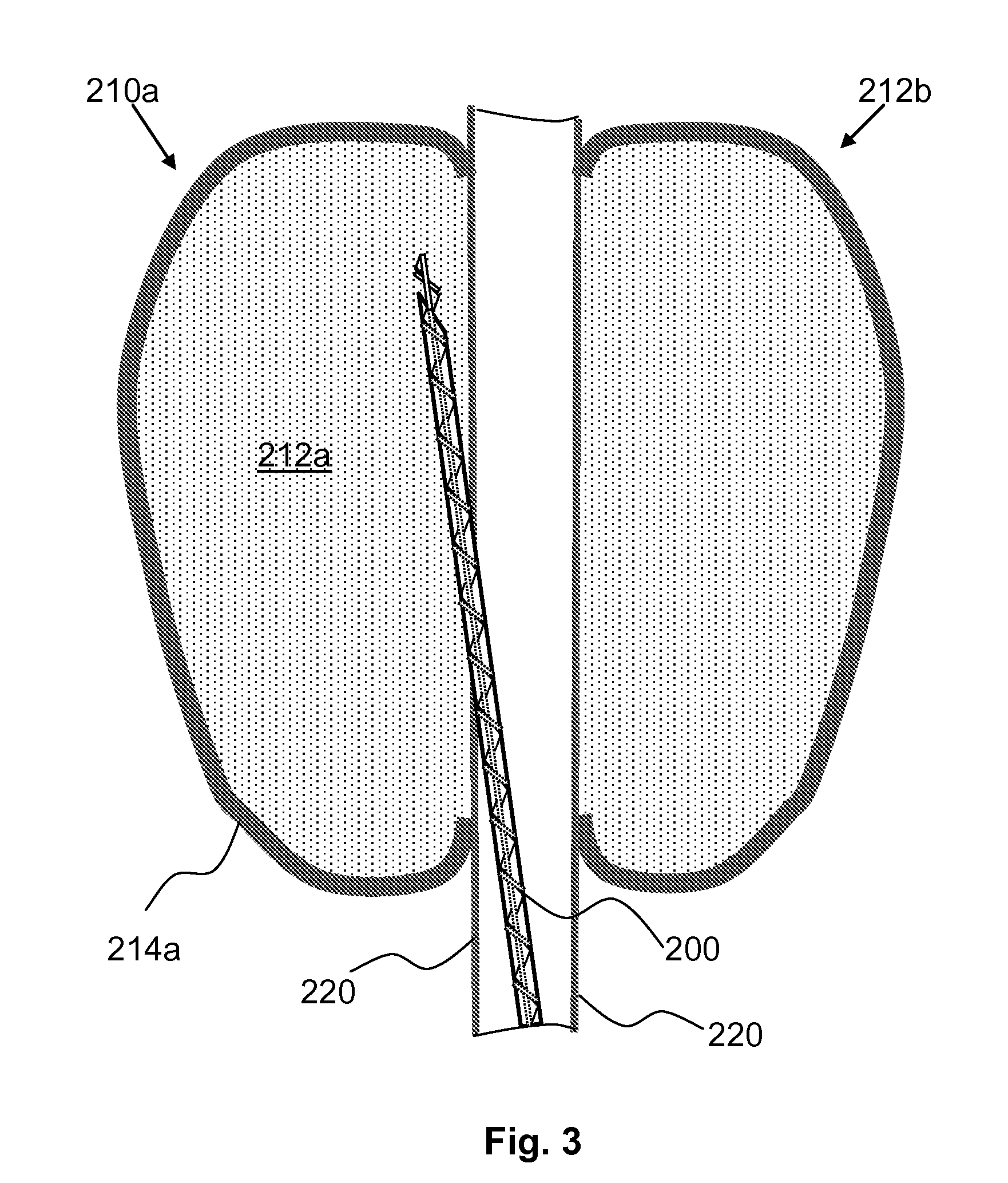 Method and device for tissue removal and for delivery of a therapeutic agent or bulking agent
