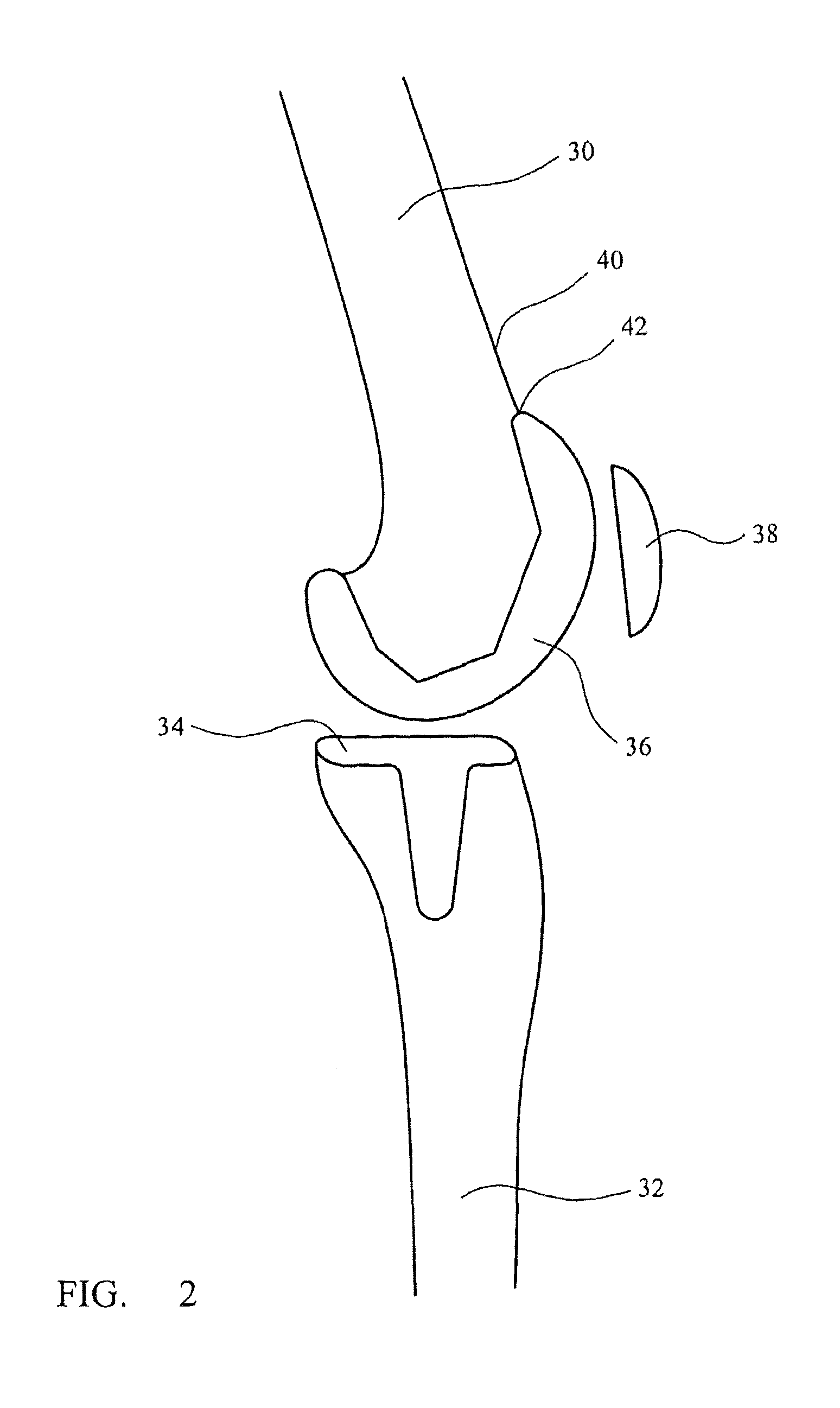 Femoral sizing instrument